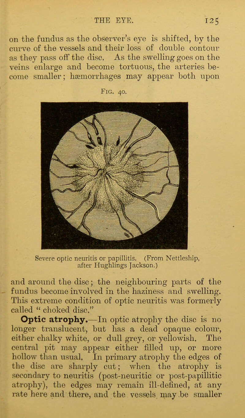 on the fundus as the observer’s eye is shifted, by the curve of the vessels and their loss of double contour as they pass off the disc. As the swelling goes on the veins enlarge and become tortuous, the arteries be- come smaller; haemorrhages may appear both upon Fig. 40. Severe optic neuritis or papillitis. (From Nettleship, after Hughlings Jackson.) and around the disc; the neighbouring parts of the fundus become involved in the haziness and swelling. This extreme condition of optic neuritis was formerly called “ choked disc.” Optic atrophy.—In optic atrophy the disc is no longer translucent, but has a dead opaque colour, either chalky white, or dull grey, or yellowish. The central pit may appear either filled up, or more hollow than usual. In primary atrophy the edges of the disc are sharply cut; when the atrophy is secondary to neuritis (post-neuritic or post-papillitic atrophy), the edges may remain ill-defined, at any rate here and there, and the vessels may be smaller