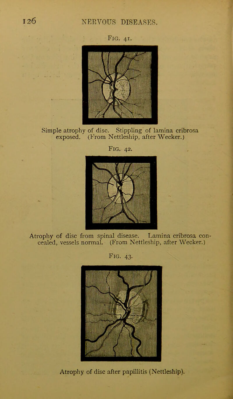 Fig. 41. Simple atrophy of disc. Stippling of lamina cribrosa exposed. (From Nettleship, after Wecker.) Fig. 42. Atrophy of disc from spinal disease. Lamina cribrosa con- cealed, vessels normal. (From Nettleship, after Wecker.) Fig. 43. Atrophy of disc after papillitis (Nettleship).