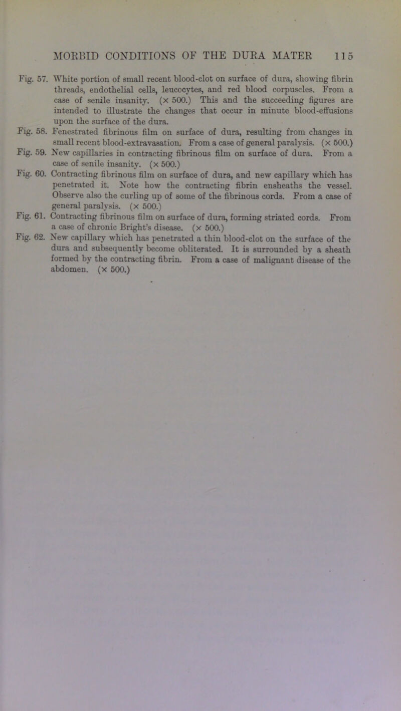 Fig. 57. White portion of small recent blood-clot on surface of dura, showing fibrin threads, endothelial cells, leucocytes, and red blood corpuscles. From a case of senile insanity, (x 500.) This and the succeeding figures are intended to illustrate the changes that occur in minute blood-effusions upon the surface of the dura. Fig. 58. Fenestrated fibrinous film on surface of dura, resulting from changes in small recent blood-extravasation. From a case of general paralysis, (x 500.) Fig. 59. New capillaries in contracting fibrinous film on surface of dura. From a case of senile insanity, (x 500.) Fig. 60. Contracting fibrinous film on surface of dura, and new capillary which has penetrated it. Note how the contracting fibrin ensheaths the vessel. Observe also the curling up of some of the fibrinous cords. From a case of general paralysis, (x 500.) Fig. 61. Contracting fibrinous film on surface of dura, forming striated cords. From a case of chronic Bright’s disease, (x 500.) Fig. 62. New capillary which has penetrated a thin blood-clot on the surface of the dura and subsequently become obliterated. It is surrounded by a sheath formed by the contracting fibrin. From a case of malignant disease of the abdomen, (x 500.)
