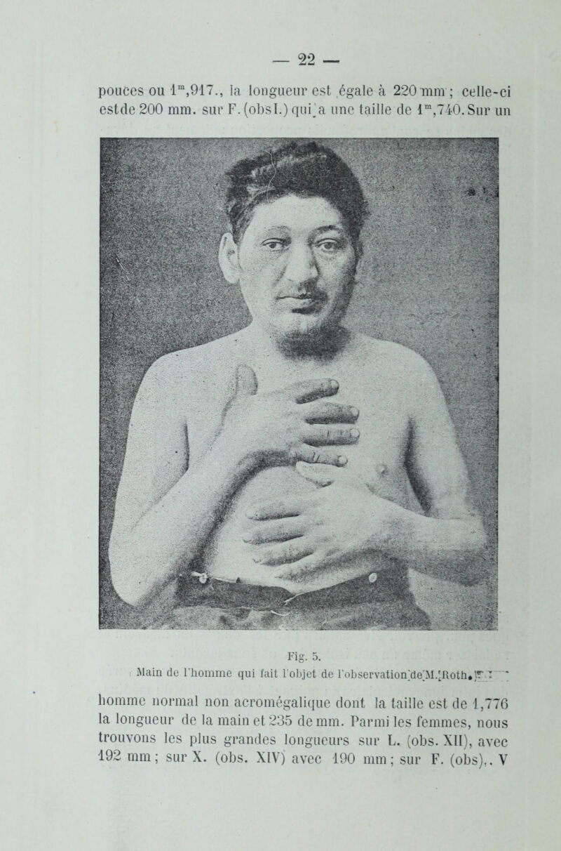 pouces ou lm,917., la longueur est égale à 220mm ; celle-ci estde 200 mm. sur F. (obsl.) quFa une taille de lm,740.Sur un Main de l’homme qui fait l'objet de l’observation;de[M.'Rotin }?* T ' homme normal non acromégalique dont la taille est de 1,776 la longueur de la main et 235 de mm. Parmi les femmes, nous trouvons les plus grandes longueurs sur L. (obs. XII), avec 192 mm; sur X. (obs. XIV) avec 190 mm; sur F. (obs),. V