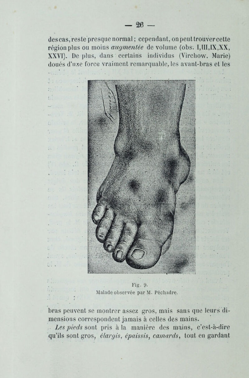 descas, reste presque normal; cependant, on peut trouver cette région plus ou moins augmentée de volume (obs. I,III,IX,XX, XXVI), De plus, dans certains individus (Virchow, Marie) doués d'uae force vraiment remarquable, les avant-bras et les Fig. 9. Malade observée par M. Pêchadre. bras peuvent se montrer assez gros, mais sans que leurs di- mensions correspondent jamais à celles des mains. Les pieds sont pris à la manière des mains, c’est-à-dire qu’ils sont gros, élargis, épaissis, camards, tout en gardant