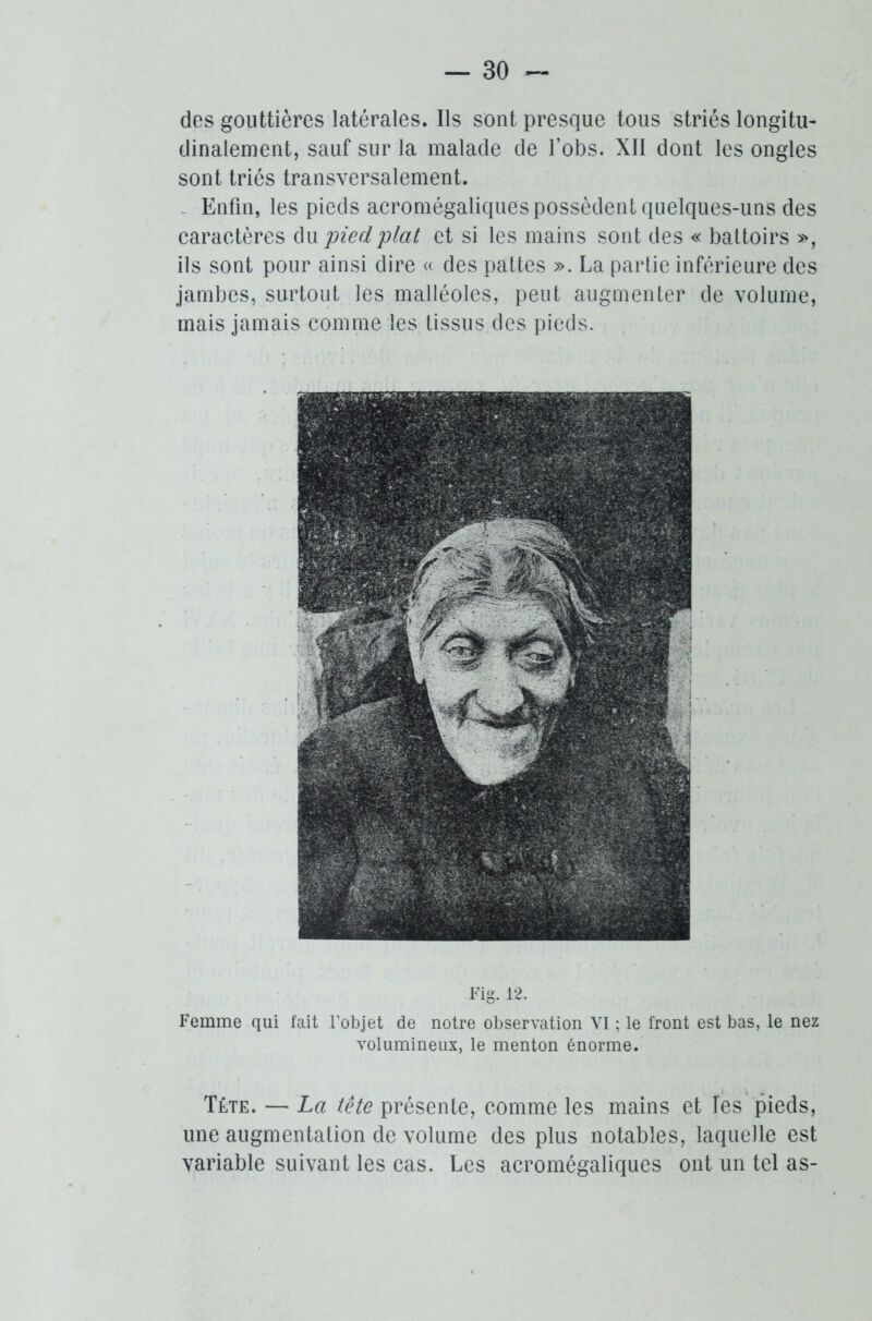 des gouttières latérales. Ils sont presque tous striés longitu- dinalement, sauf sur la malade de Lobs. XII dont les ongles sont triés transversalement. Enfin, les pieds acromégaliques possèdent quelques-uns des caractères du pied plat et si les mains sont des « battoirs », ils sont pour ainsi dire « des pattes ». La partie inférieure des jambes, surtout les malléoles, peut augmenter de volume, mais jamais comme les tissus des pieds. Fig. 12. Femme qui fait l'objet de notre observation VI ; le front est bas, le nez volumineux, le menton énorme. Tête. — La tête présente, comme les mains et îes pieds, une augmentation de volume des plus notables, laquelle est variable suivant les cas. Les acromégaliques ont un tel as-