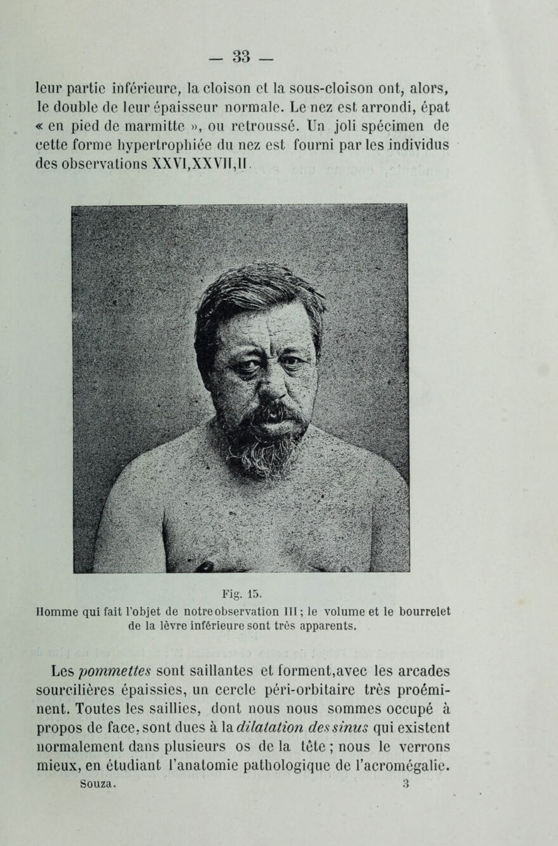 leur partie inférieure, la cloison et la sous-cloison ont, alors, le double de leur épaisseur normale. Le nez est arrondi, épat « en pied de marmitte », ou retroussé. Un joli spécimen de cette forme hypertrophiée du nez est fourni parles individus des observations XXV1,XXVJT,1L Fig. 15. Homme qui fait l’objet de notre observation III; le volume et le bourrelet de la lèvre inférieure sont très apparents. Les 'pommettes sont saillantes et forment,avec les arcades sourcilières épaissies, un cercle péri-orbitaire très proémi- nent. Toutes les saillies, dont nous nous sommes occupé à propos de face,sont dues a \&düatation dessinus qui existent normalement dans plusieurs os de la tête ; nous le verrons mieux, en étudiant l’anatomie pathologique de l’acromégalie. Souza. 3