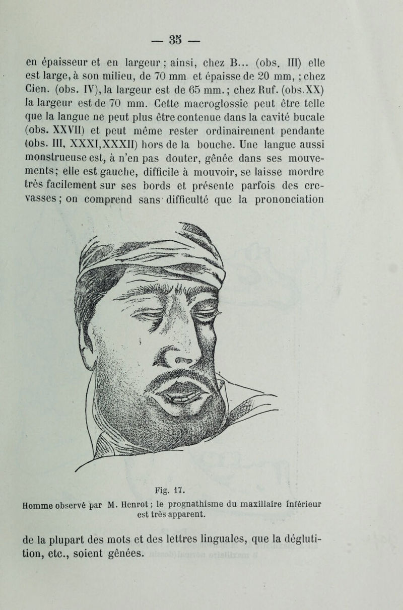en épaisseur et en largeur ; ainsi, chez B... (obs. III) elle est large, à son milieu, de 70 mm et épaisse de 20 mm, ; chez Gien. (obs. IV), la largeur est de 65 mm. ; chez Ruf. (obs.XX) la largeur est de 70 mm. Cette macroglossie peut être telle que la langue ne peut plus être contenue dans la cavité bucale (obs. XXVII) et peut même rester ordinairement pendante (obs. III, XXXI,XXXII) hors de la bouche. Une langue aussi monstrueuse est, à n’en pas douter, gênée dans ses mouve- ments; elle est gauche, difficile à mouvoir, se laisse mordre très facilement sur ses bords et présente parfois des cre- vasses ; on comprend sans difficulté que la prononciation Fig. 17. Homme observé par M. Henrot ; le prognathisme du maxillaire inférieur est très apparent. de la plupart des mots et des lettres linguales, que la dégluti- tion, etc., soient gênées.
