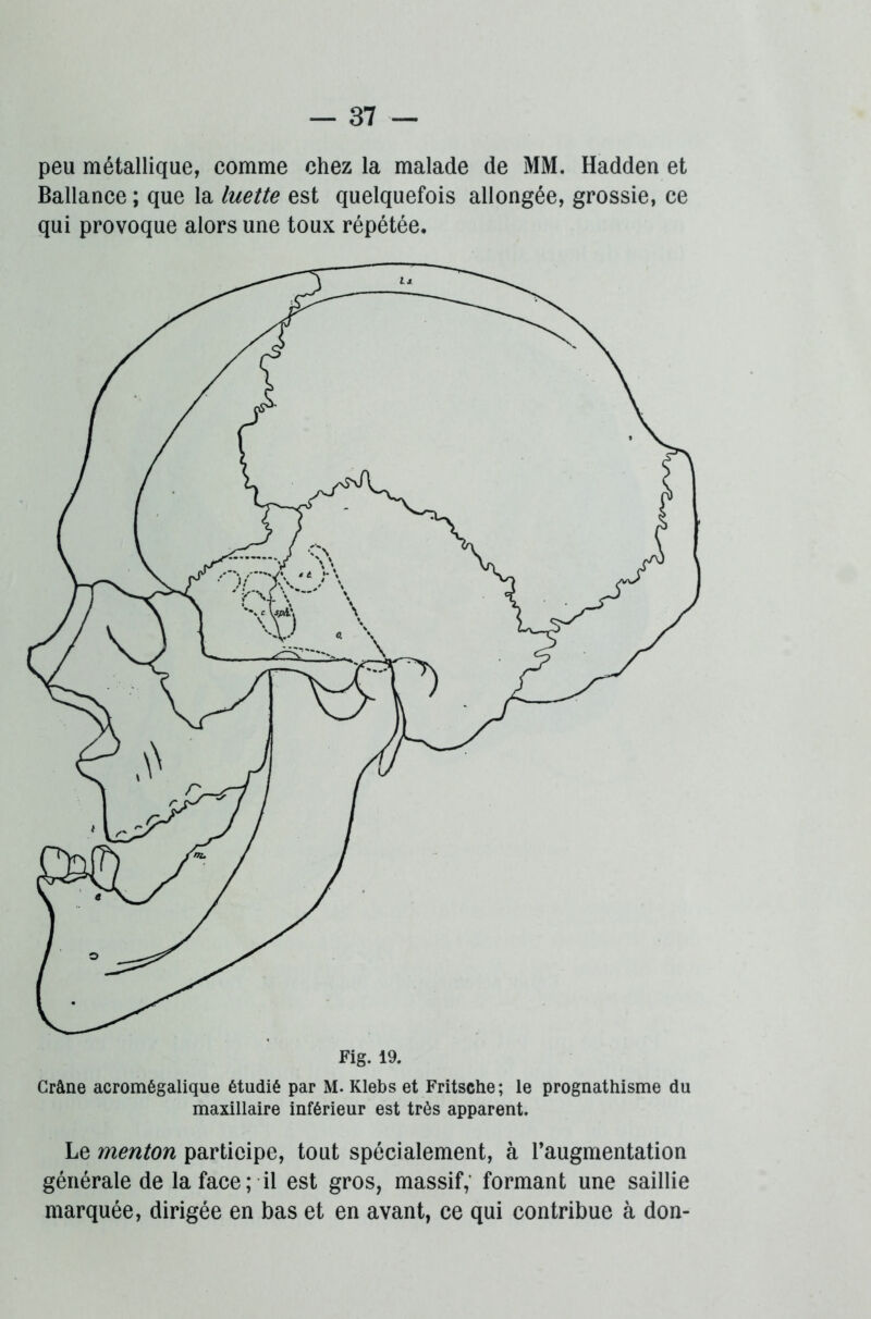 peu métallique, comme chez la malade de MM. Hadden et Ballance ; que la luette est quelquefois allongée, grossie, ce qui provoque alors une toux répétée. Crâne acromégalique étudié par M. Klebs et Fritsche ; le prognathisme du maxillaire inférieur est très apparent. Le menton participe, tout spécialement, à l’augmentation générale de la face; il est gros, massif, formant une saillie marquée, dirigée en bas et en avant, ce qui contribue à don-