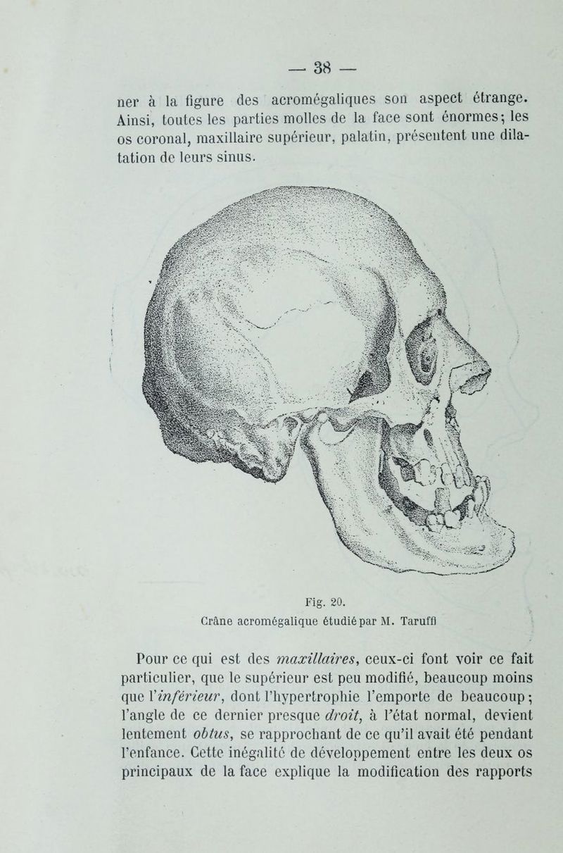 ner à la figure des acromégaliques son aspect étrange. Ainsi, toutes les parties molles de la face sont énormes-, les os coronal, maxillaire supérieur, palatin, présentent une dila- tation de leurs sinus. Fig. 20. Crâne acromégalique étudié par M. Taruffl Pour ce qui est des maxillaires, ceux-ci font voir ce fait particulier, que le supérieur est peu modifié, beaucoup moins que \'inférieur, dont l’hypertrophie l’emporte de beaucoup -, l’angle de ce dernier presque droit, à Pétât normal, devient lentement obtus, se rapprochant de ce qu’il avait été pendant l’enfance. Cette inégalité de développement entre les deux os principaux de la face explique la modification des rapports
