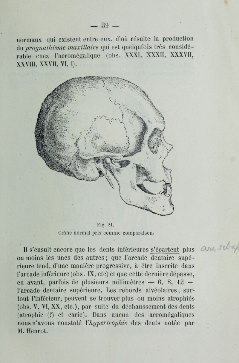 normaux qui existent entre eux, d’où résulte la production du prognathisme maxillaire qui est quelqufois très considé- rable chez l’acromégalique (obs. XXXI, XXXII, XXXVII, XXVIII, XXVII, VI, I). Il s’ensuit encore que les dents inférieures s’écartent plus ou moins les unes des autres ; que l’arcade dentaire supé- rieure tend, d’une manière progressive, à être inscrite dans l’arcade inférieure (obs. IX, etc) et que cette dernière dépasse, en avant, parfois de plusieurs millimètres — 6, 8, 12 — l’arcade dentaire supérieure. Les rebords alvéolaires, sur- tout l’inférieur, peuvent se trouver plus ou moins atrophiés (obs. V, VI, XX, etc.), par suite du déchaussement des dents (atrophie (?) et carie). Dans aucun des acromégaliques nous n'avons constaté Xhypertrophie des dents notée par M. Henrot.