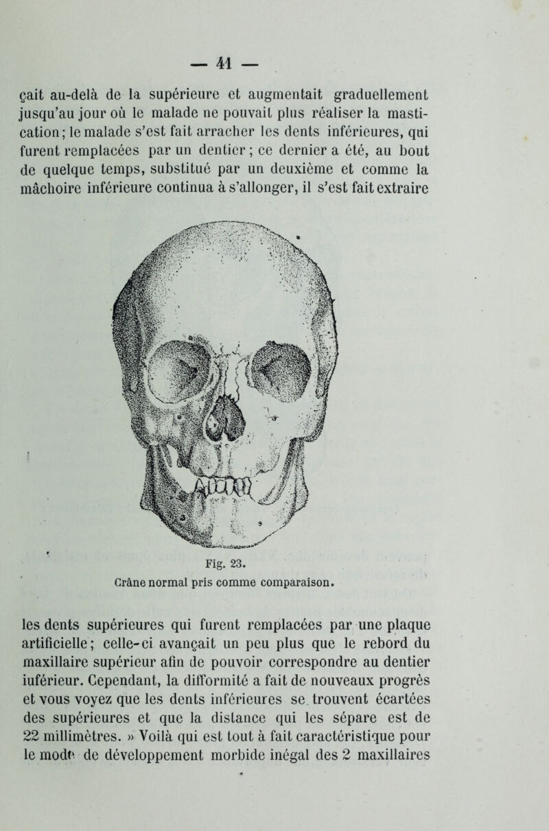 çait au-delà de la supérieure et augmentait graduellement jusqu’au jour où le malade ne pouvait plus réaliser la masti- cation; le malade s’est fait arracher les dents inférieures, qui furent remplacées par un dentier ; ce dernier a été, au bout de quelque temps, substitué par un deuxième et comme la mâchoire inférieure continua à s’allonger, il s’est fait extraire Fig. 23. Crâne normal pris comme comparaison. les dents supérieures qui furent remplacées par une plaque artificielle; celle-ci avançait un peu plus que le rebord du maxillaire supérieur afin de pouvoir correspondre au dentier iuférieur. Cependant, la difformité a fait de nouveaux progrès et vous voyez que les dents inférieures se. trouvent écartées des supérieures et que la distance qui les sépare est de 22 millimètres. » Voilà qui est tout à fait caractéristique pour le mode de développement morbide inégal des 2 maxillaires