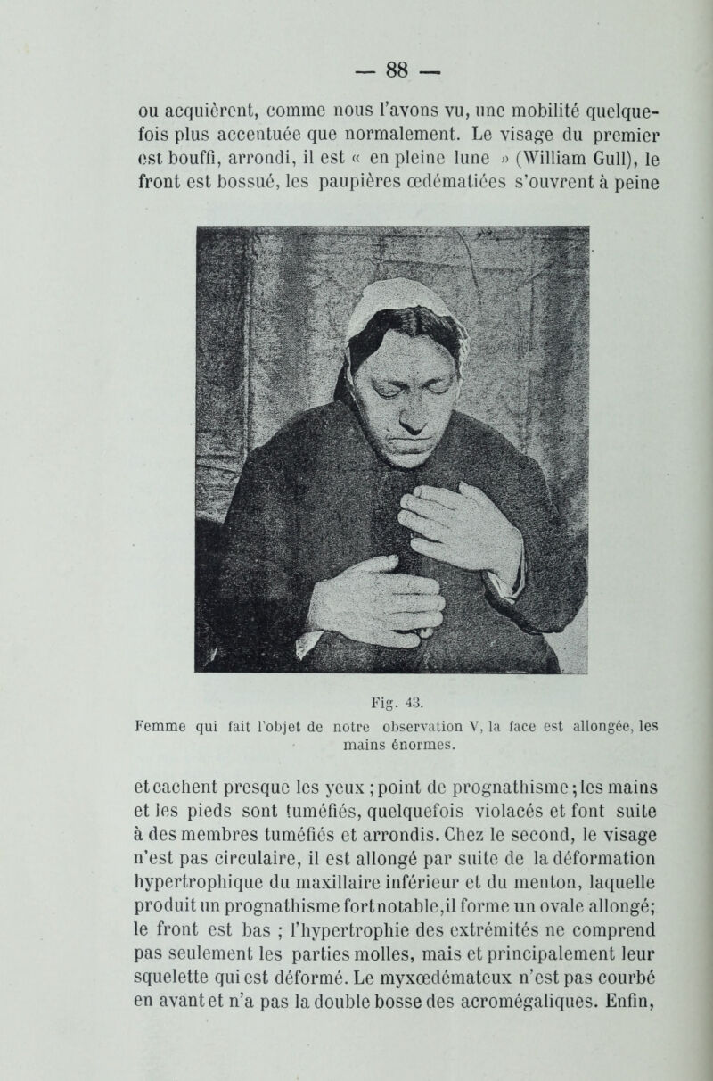 ou acquièrent, comme nous l’avons vu, une mobilité quelque- fois plus accentuée que normalement. Le visage du premier est bouffi, arrondi, il est « en pleine lune » (William Gull), le front est bossué, les paupières œdématiées s’ouvrent à peine Fig. 43. Femme qui fait l’objet de notre observation V, la face est allongée, les mains énormes. et cachent presque les yeux ; point de prognathisme-, les mains et les pieds sont tuméfiés, quelquefois violacés et font suite à des membres tuméfiés et arrondis. Chez le second, le visage n’est pas circulaire, il est allongé par suite de la déformation hypertrophique du maxillaire inférieur et du menton, laquelle produit un prognathisme fortnotable,il forme un ovale allongé; le front est bas ; l’hypertrophie des extrémités ne comprend pas seulement les parties molles, mais et principalement leur squelette qui est déformé. Le myxœdémateux n’est pas courbé en avant et n’a pas la double bosse des acromégaliques. Enfin,