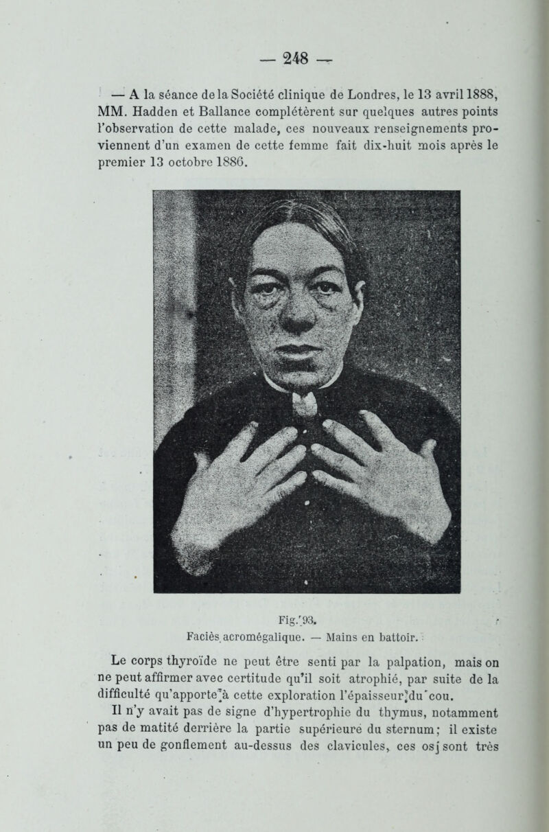 — A la séance de la Société clinique de Londres, le 13 avril 1888, MM. Hadden et Ballance complétèrent sur quelques autres points l’observation de cette malade, ces nouveaux renseignements pro- viennent d’un examen de cette femme fait dix-huit mois après le premier 13 octobre 1886. Fig/93. Faciès acromégalique. — Mains en battoir. Le corps thyroïde ne peut être senti par la palpation, mais on ne peut affirmer avec certitude qu’il soit atrophié, par suite de la difficulté qu’apporte’à cette exploration l’épaisseur^du'cou. Il n’y avait pas de signe d’hypertrophie du thymus, notamment pas de matité derrière la partie supérieure du sternum; il existe un peu de gonflement au-dessus des clavicules, ces osj sont très