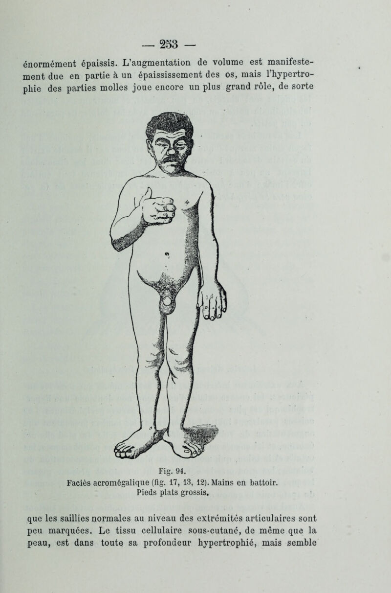 énormément épaissis. L’augmentation de volume est manifeste- ment due en partie à un épaississement des os, mais l’hypertro- phie des parties molles joue encore un plus grand rôle, de sorte Fig. 94. Faciès acromêgalique (fig. 17, 13, 12). Mains en battoir. Pieds plats grossis. que les saillies normales au niveau des extrémités articulaires sont peu marquées. Le tissu cellulaire sous-cutané, de même que la peau, est dans toute sa profondeur hypertrophié, mais semble