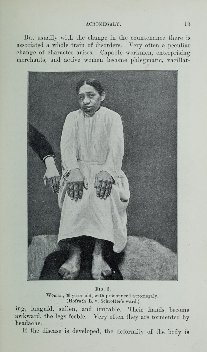 But usually with the change in the countenance there is associated a whole train of disorders. Very often a peculiar change of character arises. Capable workmen, enterprising merchants, and active women become phlegmatic, vacillat- Fig. 3. Woman, 36 years old, with pronounced acromegaly. (Hofrath L. v. Schrötter’s ward.) ing, languid, sullen, and irritable. Their hands become awkward, the legs feeble. Very often they are tormented by headache. If the disease is developed, the deformity of the body is