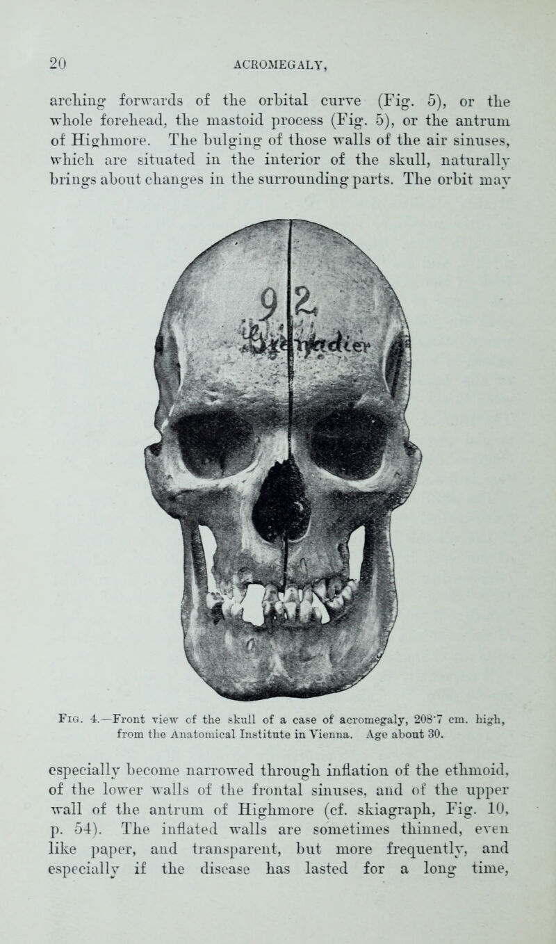 arching forwards of the orbital curve (Fig. 5), or the whole forehead, the mastoid process (Fig. 5), or the antrum of Highmore. The bulging of those walls of the air sinuses, which are situated in the interior of the skull, naturally brings about changes in the surrounding parts. The orbit may Fig. 4.—Front view of the skull of a case of acromegaly, 208*7 cm. high, from the Anatomical Institute in Vienna. Age about 30. especially become narrowed through inflation of the ethmoid, of the lower walls of the frontal sinuses, and of the upper wall of the antrum of Highmore (cf. skiagraph, Fig. 10, p. 54). The inflated walls are sometimes thinned, even like p^per, and transparent, but more frequently, and especially if the disease has lasted for a long time,