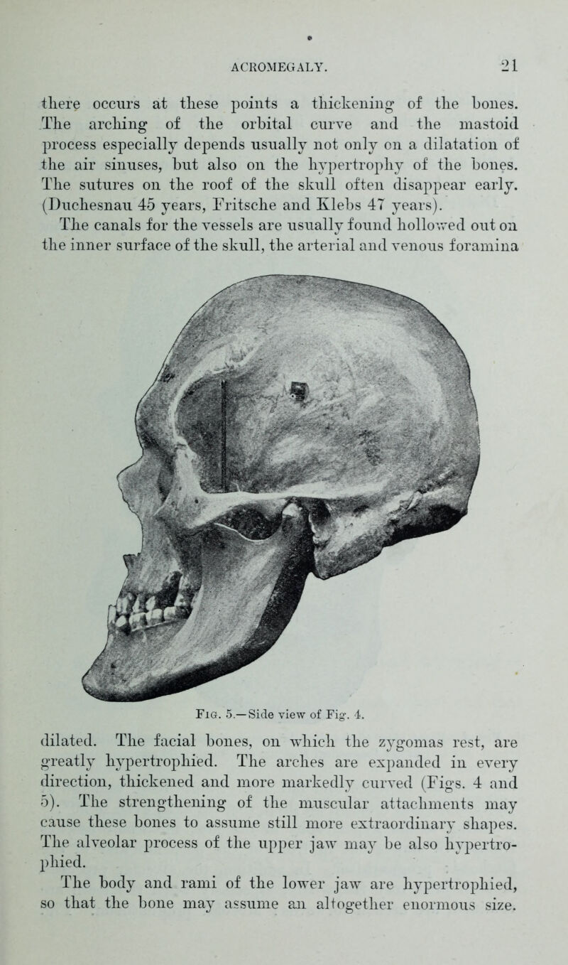 there occurs at these points a thickening of the hones. The arching of the orbital curve and the mastoid process especially depends usually not only on a dilatation of the air sinuses, but also on the hypertrophy of the bones. The sutures on the roof of the skull often disappear early. (Duchesnau 45 years, Fritsche and Klebs 47 years). The canals for the vessels are usually found hollowed out on the inner surface of the skull, the arterial and venous foramina Fig. 5—Side view of Fig. 4. dilated. The facial bones, on which the zygomas rest, are greatly hypertrophied. The arches are expanded in every direction, thickened and more markedly curved (Figs. 4 and 5). The strengthening of the muscular attachments may cause these bones to assume still more extraordinary shapes. The alveolar process of the upper jaw may be also hypertro- phied. The body and rami of the lower jaw are hypertrophied, so that the bone may assume an altogether enormous size.