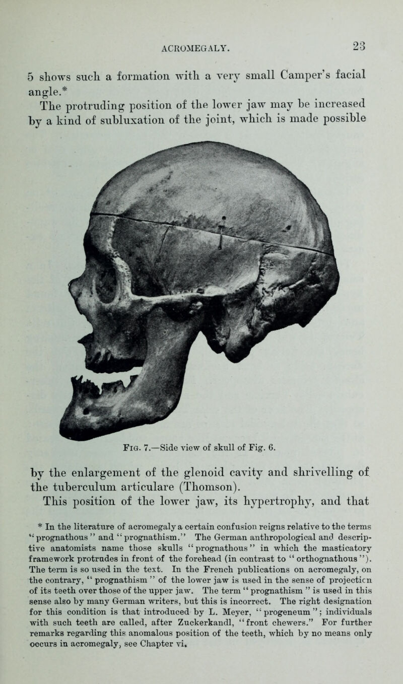 by tlie enlargement of the glenoid cavity and shrivelling of the tuberculum articulare (Thomson). This position of the lower jaw, its hypertrophy, and that * In the literature of acromegaly a certain confusion reigns relative to the terms “prognathous” and “prognathism.” The German anthropological and descrip- tive anatomists name those skulls “prognathous” in which the masticatory framework protrudes in front of the forehead (in contrast to “ orthognathous ”). The term is so used in the text. In the French publications on acromegaly, on the contrary, “ prognathism ” of the lower jaw is used in the sense of projection of its teeth over those of the upper jaw. The term “ prognathism ” is used in this sense also by many German writers, but this is incorrect. The right designation for this condition is that introduced by L. Meyer, “ progeneum ”; individuals with such teeth are called, after Zuckerkandl, “front chewers.” For further remarks regarding this anomalous position of the teeth, which by no means only occurs in acromegaly, see Chapter vi. 5 shows such a formation with a very small Camper’s facial angle.* The protruding position of the lower jaw may he increased by a kind of subluxation of the joint, which is made possible Fig. 7.—Side view of skull of Fig. 6.