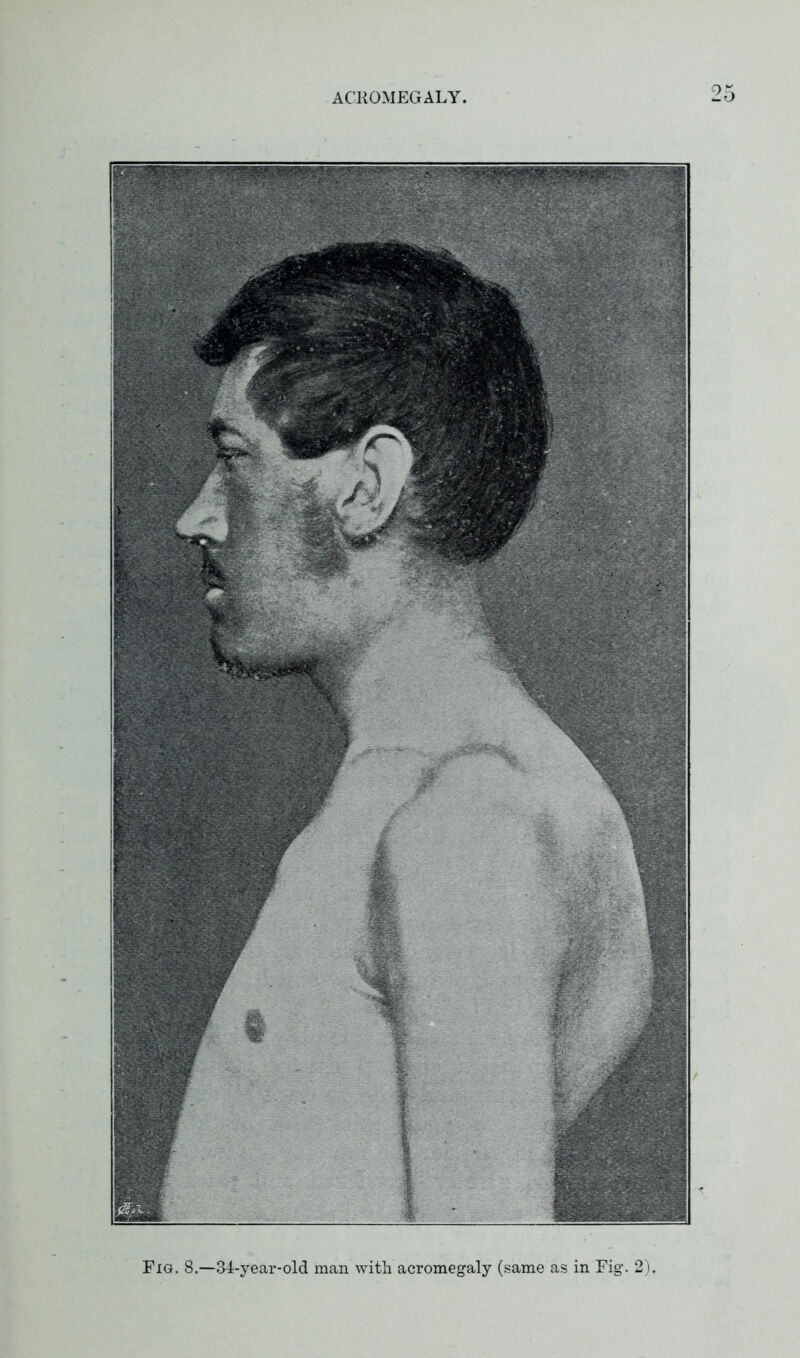 Fig. 8.—34-year-old man with acromegaly (same as in Fig. 2)