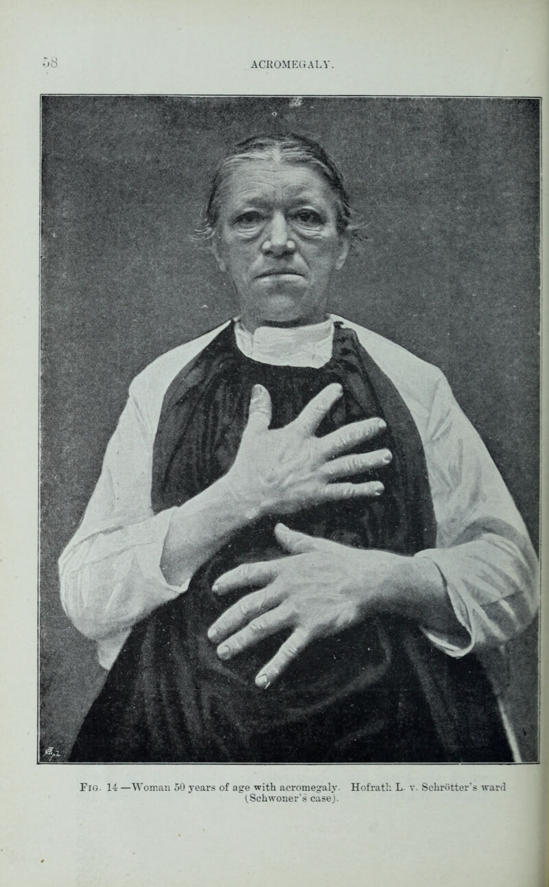 Fig. 14 —Woman 50 years of age •with acromegaly. Hofrath L. v. Schrotter’s ward (^Schwoner’s case).