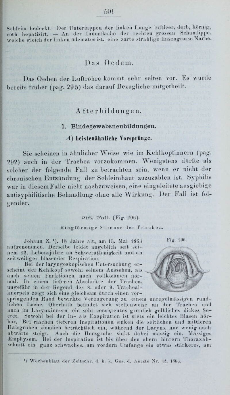 Schleiin bedeckt. Der Unterlappeii der linken Liing-e luftleer, derb, körnig-, roth liepatisirt. — An der Innentläche der rechten g-ro.ssen Scbainlippe, welche gleich der linken ödeniatös ist, eine zarte strablige linsengrosse Narbe. Das Oe dem. Das Oedein der Luftröhre kommt sehr selten vor. Es wurde bereits früher (pag. 295) das daraiit Bezügliche mitgetheilt. A f t e r i 1 d ii n g e n. 1. Bindegewebsneubildungen. -4) lieisteiiähnliche Vorsprünge. Sie scheinen in ähnlicher Weise wie im Kehlkopfinnern (pag. 292) auch in der Trachea vorznkommen. Wenigstens dürfte als solcher der folgende Fall zu betrachten sein, wenn er nicht der chronischen Entzündnng der Scldeindiant znznzählen ist. Syphilis Avar in diesem Falle nicht nachzmveisen, eine eingeleitete ausgiebige antisyphilitische Behandlung ohne alle Wirkung. Der Fall ist fol- gender. »m SK3. (Fig. 206). R i n g f ö r m i g e Stenose der T r a e li e a. Johaim Z. ‘), 18 Jalire alt, am 15. Mal 1865 aufgeiioiiniien. Derselbe leidet angeblich seit sei- nem 12. J^ebensjahre an Schwerathmigkelt und an zeitweiliger blasender Respiration. Bei der laryngoskopischen Untersuchung er- scheint der Kehlkopf sowohl seinem Aussehen, als auch seinen Funktionen nach vollkommen nor- mal. In einem tieferen Abschnitte der Trachea, ungefähr in der Gegend des 8. oder 9. Tracheal- knorpels zeigt sich eine gleichsam durch einen vor- springenden Rand bewirkte V^erengerung zu einem miregelmässigen rund- lichen Jjoche. Oberhalb befindet sich stellenweise an der Trachea und auch iin Larynxinnern ein sehr consistentes grünlich gelbliches dickes Se- cret. Sowohl bei der ln- als Exspiration ist stets ein leichtes Blasen hör- bar. Bei raschen tieferen Inspirationen sinken die seitlichen und mittleren Halsgruben ziemlich beträchtlich ein, während der Larynx nur wenig nach abwärts steigt. Auch die Herzgrube sinkt dabei inässig ein. iMässiges Emphysem. Bel der Inspiration ist bis über den obern hintern Tlioraxab- schnitt ein ganz schwaches, am vordem Umfange ein etwas stärkeres, am ') Wochenblatt der Zeitschr. d. U. k. Ges. d. Aerzte Nr. fi, 1%3. Fiir. ‘2()(i.