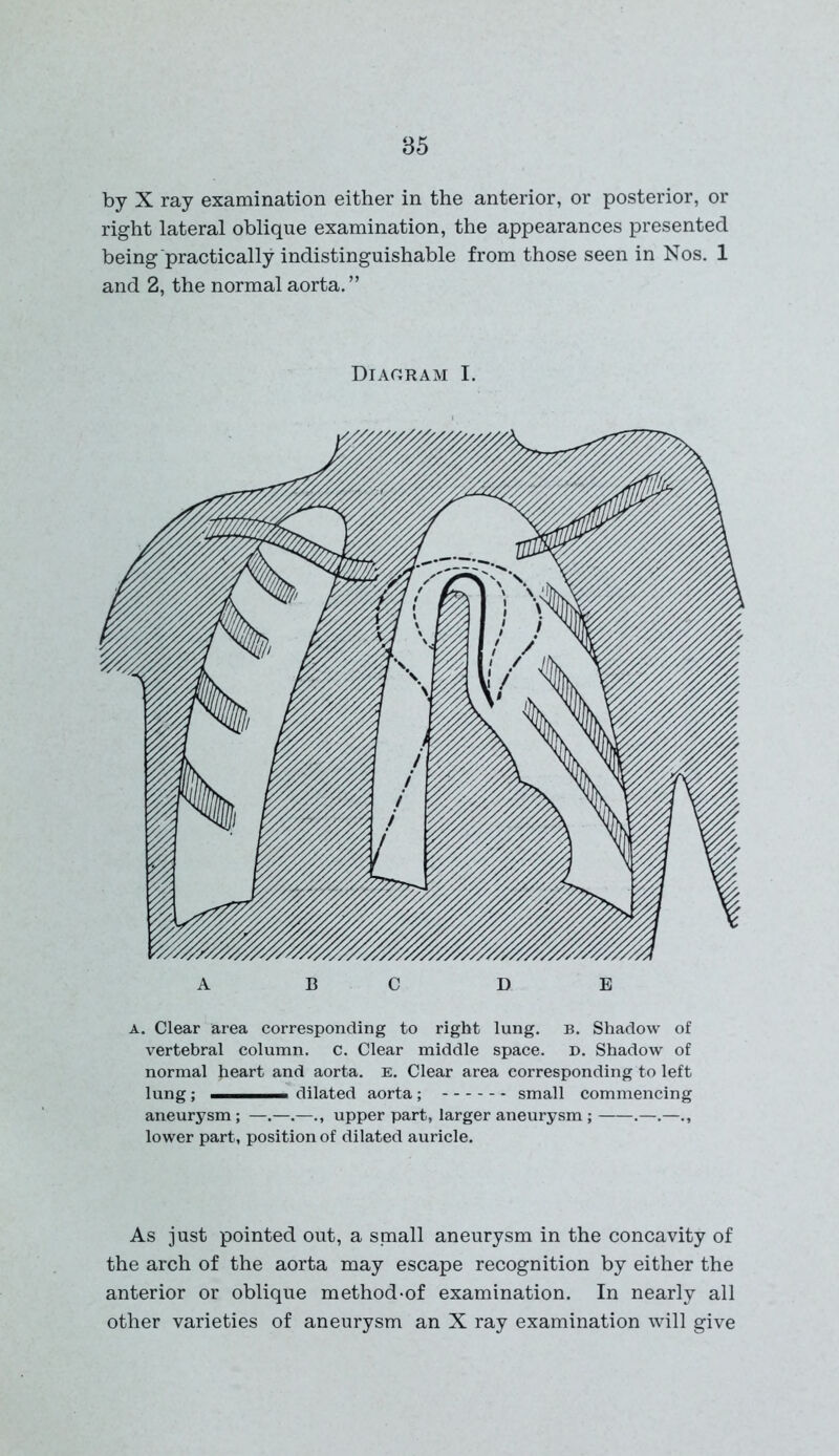 by X ray examination either in the anterior, or posterior, or right lateral oblique examination, the appearances presented being practically indistinguishable from those seen in Nos. 1 and 2, the normal aorta. ” Diagram I. A. Clear area corresponding to right lung. b. Shadow of vertebral column, c. Clear middle space, d. Shadow of normal heart and aorta. E. Clear area corresponding to left lung; dilated aorta; small commencing aneurysm; —.—.—., upper part, larger aneurysm; .—.— lower part, position of dilated auricle. As just pointed out, a small aneurysm in the concavity of the arch of the aorta may escape recognition by either the anterior or oblique method-of examination. In nearly all other varieties of aneurysm an X ray examination will give