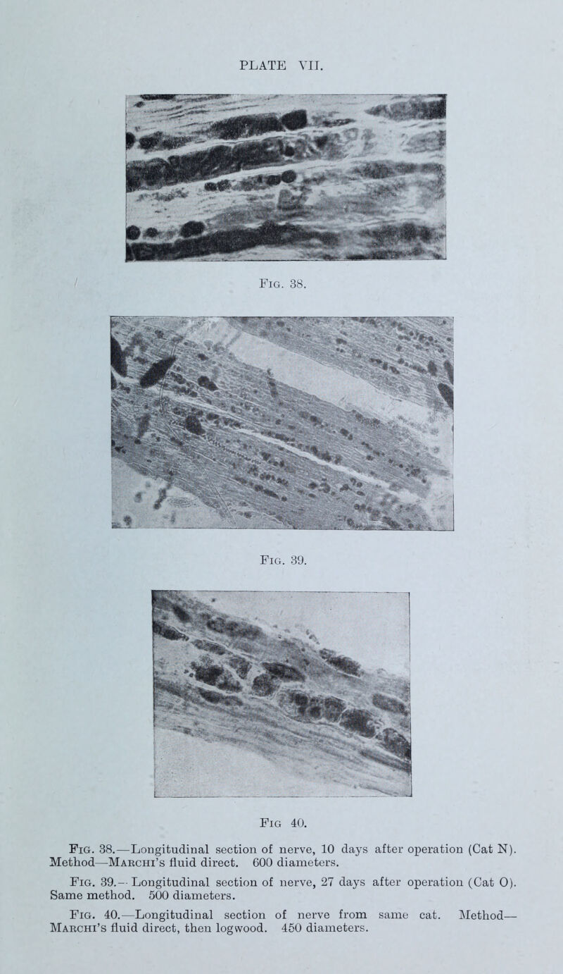 Pig. 38. Fig. 39. Fig 40. Fig. 38.—Longitudinal section of nerve, 10 days after operation (Cat N). Method—Marchi’s fluid direct. 600 diameters. Fig. 39.-- Longitudinal section of nerve, 27 days after operation (Cat 0). Same method. 500 diameters. Fig. 40.—Longitudinal section of nerve from same cat. Method— Marchi’s fluid direct, then logwood. 450 diameters.