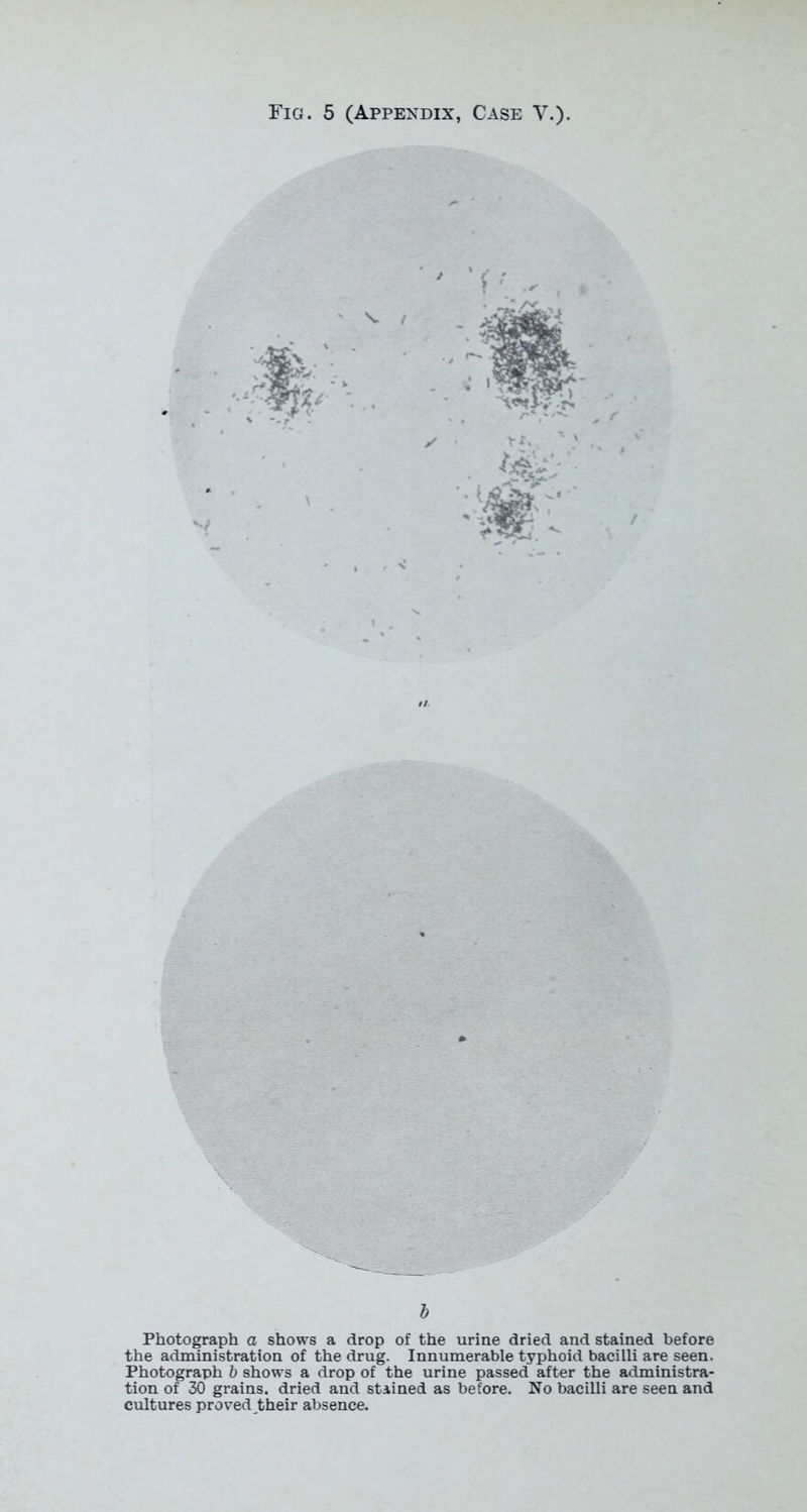 b Photograph a shows a drop of the urine dried and stained before the administration of the drug. Innumerable typhoid bacilli are seen. Photograph b shows a drop of the urine passed after the administra- tion of 30 grains, dried and stained as before. No bacilli are seen and cultures proved their absence.