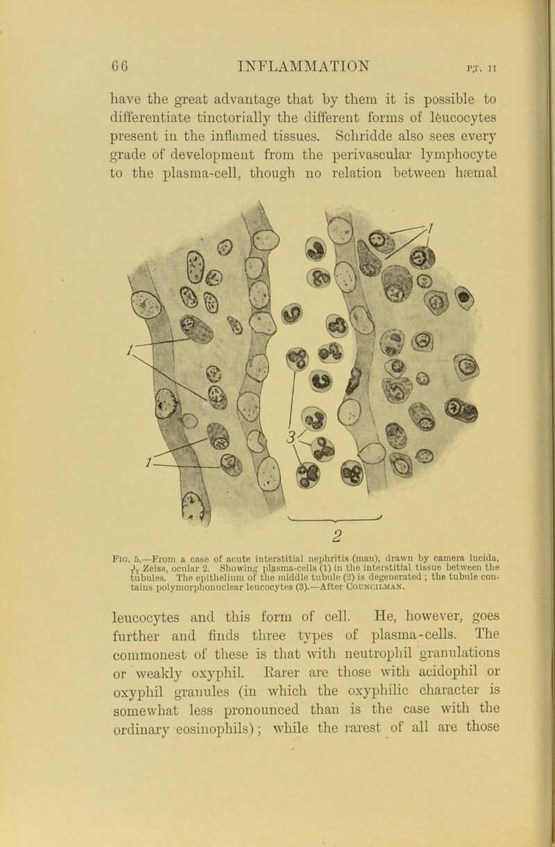 p;r. n have the great advantage that by them it is possible to differentiate tinctorially the different forms of leucocytes present in the inflamed tissues. Schridde also sees every grade of development from the perivascular lymphocyte to the plasma-cell, though no relation between haemal Fio. 5.—From a case of acute interstitial nephritis (man), drawn by camera lucida, ■f„ Zeiss, ocular 2. Showing plasma-cells (1) in the interstitial tissue between the tubules. The epithelium of the middle tubule (2) is degenerated ; the tubule con- tains polymorphonuclear leucocytes (3).—After Councilman. leucocytes and this form of cell. He, however, goes further and finds three types of plasma - cells. The commonest of these is that with neutrophil granulations or weakly oxyphil. Rarer are those with acidophil or oxyphil granules (in which the oxyphilic character is somewhat less pronounced than is the case with the ordinary eosinophils); while the rarest of all are those