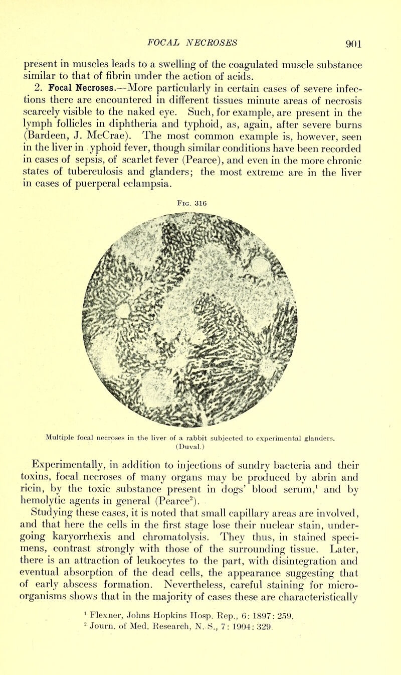 FOCAL NECROSES 9U1 present in muscles leads to a swelling of the coagulated muscle substance similar to that of fibrin under the action of acids. 2. Focal Necroses.—More particularly in certain cases of severe infec- tions there are encountered in different tissues minute areas of necrosis scarcely visible to the naked eye. Such, for example, are present in the lymph follicles in diphtheria and typhoid, as, again, after severe burns (Bardeen, J. McCrae). The most common example is, however, seen in the liver in yphoid fever, though similar conditions have been recorded in cases of sepsis, of scarlet fever (Pearce), and even in the more chronic states of tuberculosis and glanders; the most extreme are in the liver in cases of puerperal eclampsia. Fig. 316 Multiple focal necroses in the liver of a rabbit subjected to experimental glanders. (Duval.) Experimentally, in addition to injections of sundry bacteria and their toxins, focal necroses of many organs may be produced by abrin and ricin, by the toxic substance present in dogs’ blood serum,1 and by hemolytic agents in general (Pearce2). Studying these cases, it is noted that small capillary areas are involved, and that here the cells in the first stage lose their nuclear stain, under- going karyorrhexis and chromatolysis. They thus, in stained speci- mens, contrast strongly with those of the surrounding tissue. Later, there is an attraction of leukocytes to the part, with disintegration and eventual absorption of the dead cells, the appearance suggesting that of early abscess formation. Nevertheless, careful staining for micro- organisms shows that in the majority of cases these are characteristically 1 Flexner, Johns Hopkins Hosp. Rep., 6: 1897: 259.