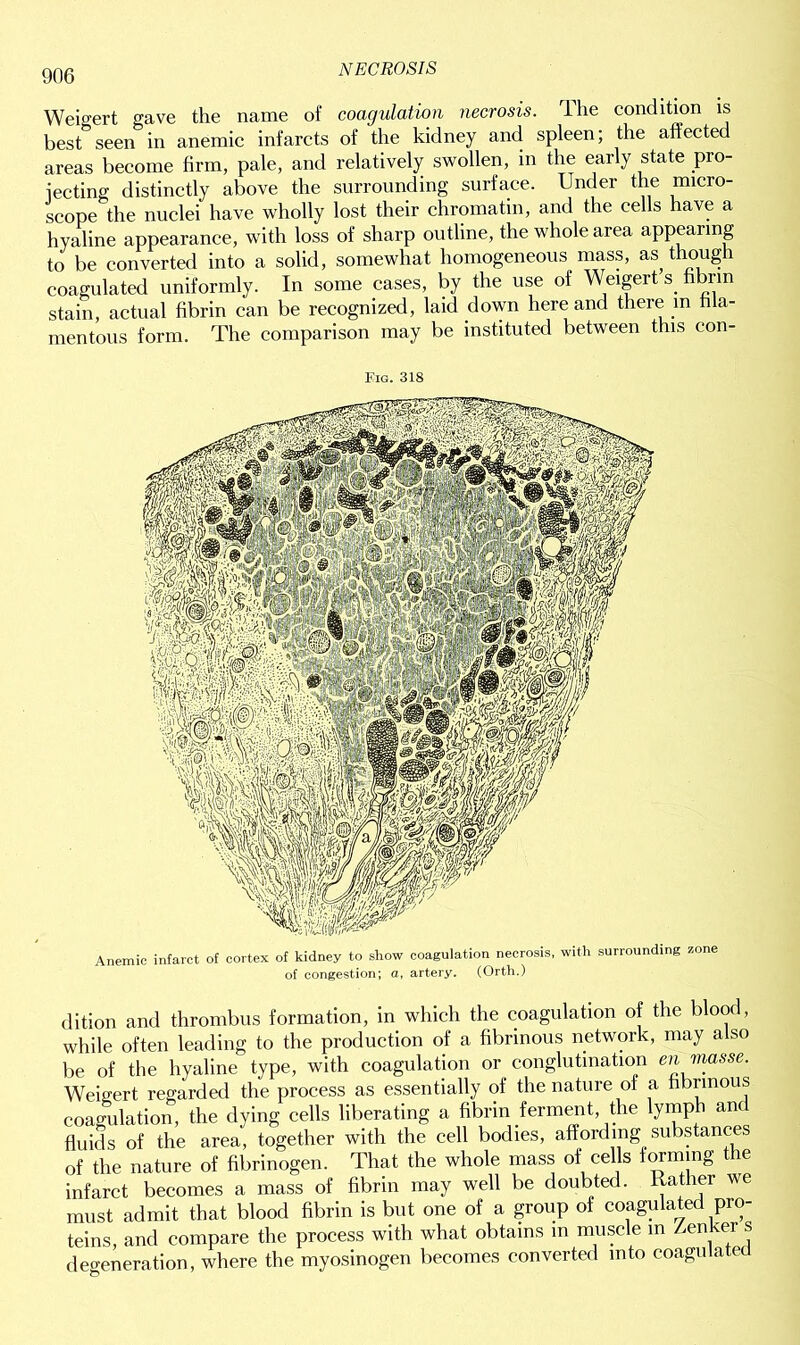 Weigert gave the name of coagulation necrosis. The condition is best seen in anemic infarcts of the kidney and spleen; the affected areas become firm, pale, and relatively swollen, in the early state pro- moting distinctly above the surrounding surface. Under the micro- scope the nuclei have wholly lost their chromatin, and the cells have a hyaline appearance, with loss of sharp outline, the whole area appearing to be converted into a solid, somewhat homogeneous mass, as though coagulated uniformly. In some cases, by the use of Weigert s. fibrin stain, actual fibrin can be recognized, laid down here and there in fila- mentous form. The comparison may be instituted between this con- Fig. 318 Anemic infarct of cortex of kidney to show coagulation necrosis, with surrounding zone of congestion; a, artery. (Orth.) dition and thrombus formation, in which the coagulation of the blood, while often leading to the production of a fibrinous network, may also be of the hyaline type, with coagulation or conglutination en masse. Weigert regarded the process as essentially of the nature of a fibrinous coagulation, the dying cells liberating a fibrin ferment, the lymph an fluids of the area, together with the cell bodies, affording substances of the nature of fibrinogen. That the whole mass of cells forming the infarct becomes a mass of fibrin may well be doubted, llather we must admit that blood fibrin is but one of a group of coagulated pro- teins, and compare the process with what obtains in muscle m Zenker s degeneration, where the myosinogen becomes converted into coagulated