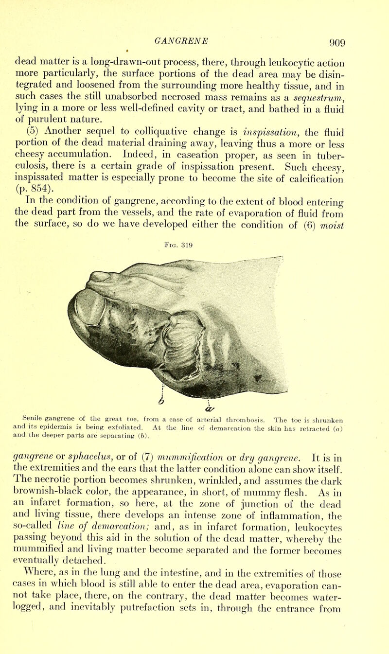 GANGRENE dead matter is a long-drawn-out process, there, through leukocytic action more particularly, the surface portions of the dead area may be disin- tegrated and loosened from the surrounding more healthy tissue, and in such cases the still unabsorbed necrosed mass remains as a sequestrum, lying in a more or less well-defined cavity or tract, and bathed in a fluid of purulent nature. (5) Another sequel to colliquative change is inspissation, the fluid portion of the dead material draining away, leaving thus a more or less cheesy accumulation. Indeed, in caseation proper, as seen in tuber- culosis, there is a certain grade of inspissation present. Such cheesy, inspissated matter is especially prone to become the site of calcification (p. 854). In the condition of gangrene, according to the extent of blood entering the dead part from the vessels, and the rate of evaporation of fluid from the surface, so do we have developed either the condition of (6) vioist Fig. 319 Senile gangrene of the great toe, from a case of arterial thrombosis. The toe is shrunken and its epidermis is being exfoliated. At the line of demarcation the skin has retracted (a) and the deeper parts are separating (fib). gangrene or sphacelus, or of (7) mummification or dry gangrene. It is in the extremities and the ears that the latter condition alone can show7 itself. The necrotic portion becomes shrunken, wrinkled, and assumes the dark brownish-black color, the appearance, in short, of mummy flesh. As in an infarct formation, so here, at the zone of junction of the dead and living tissue, there develops an intense zone of inflammation, the so-called line of demarcation; and, as in infarct formation, leukocytes passing beyond this aid in the solution of the dead matter, whereby the mummified and living matter become separated and the former becomes eventually detached. Where, as in the lung and the intestine, and in the extremities of those cases in which blood is still able to enter the dead area, evaporation can- not take place, there, on the contrary, the dead matter becomes water- logged , and inevitably putrefaction sets in, through the entrance from