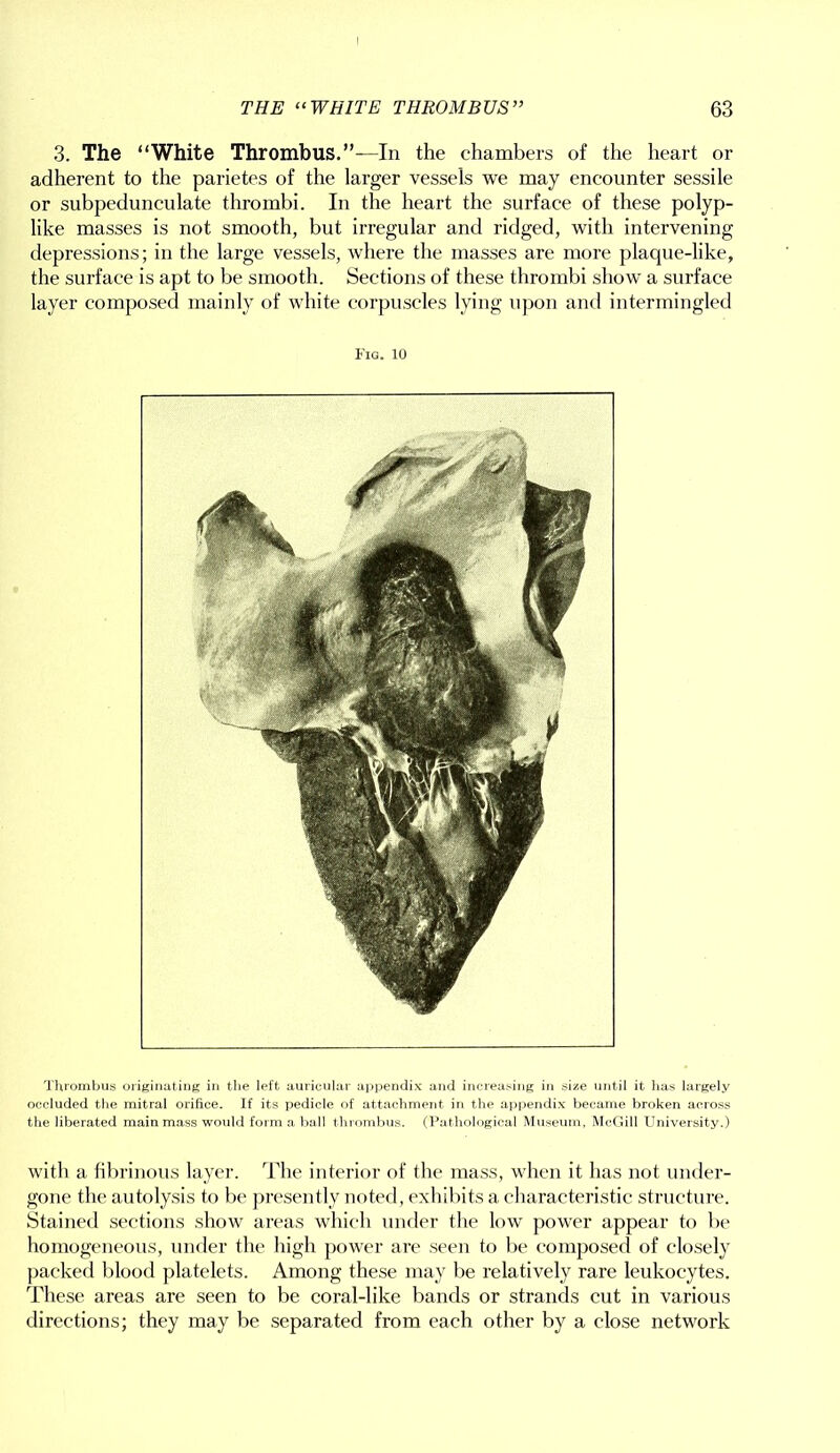 3. The “White Thrombus.”—In the chambers of the heart or adherent to the parietes of the larger vessels we may encounter sessile or subpedunculate thrombi. In the heart the surface of these polyp- like masses is not smooth, but irregular and ridged, with intervening depressions; in the large vessels, where the masses are more plaque-like, the surface is apt to be smooth. Sections of these thrombi show a surface layer composed mainly of white corpuscles lying upon and intermingled Fig. 10 Thrombus originating in the left auricular appendix and increasing in size until it has largely occluded the mitral orifice. If its pedicle of attachment in the appendix became broken across the liberated main mass would form a ball thrombus. (Pathological Museum, McGill University.) with a fibrinous layer. The interior of the mass, when it has not under- gone the autolysis to be presently noted, exhibits a characteristic structure. Stained sections show areas which under the low power appear to be homogeneous, under the high power are seen to be composed of closely packed blood platelets. Among these may be relatively rare leukocytes. These areas are seen to be coral-like bands or strands cut in various directions; they may be separated from each other by a close network