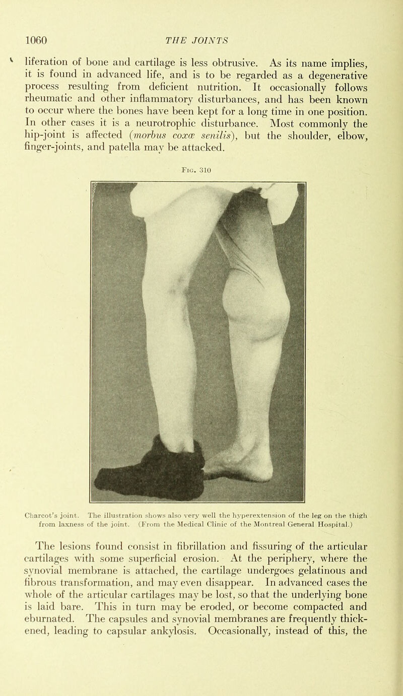 liferation of bone and cartilage is less obtrusive. As its name implies, it is found in advanced life, and is to be regarded as a degenerative process resulting from deficient nutrition. It occasionally follows rheumatic and other inflammatory disturbances, and has been known to occur where the bones have been kept for a long time in one position. In other cases it is a neurotrophic disturbance. Most commonly the hip-joint is affected (morbus coxae senilis), but the shoulder, elbow, finger-joints, and patella may be attacked. Fig. 310 Charcot’s joint. The illustration shows also very well the hyperextension of the leg on the thigh from laxness of the joint. (From the Medical Clinic of the Montreal General Hospital.) The lesions found consist in fibrillation and Assuring of the articular cartilages with some superficial erosion. At the periphery, where the synovial membrane is attached, the cartilage undergoes gelatinous and fibrous transformation, and may even disappear. In advanced cases the whole of the articular cartilages may be lost, so that the underlying bone is laid bare. This in turn may be eroded, or become compacted and eburnated. The capsules and synovial membranes are frequently thick- ened, leading to capsular ankylosis. Occasionally, instead of this, the