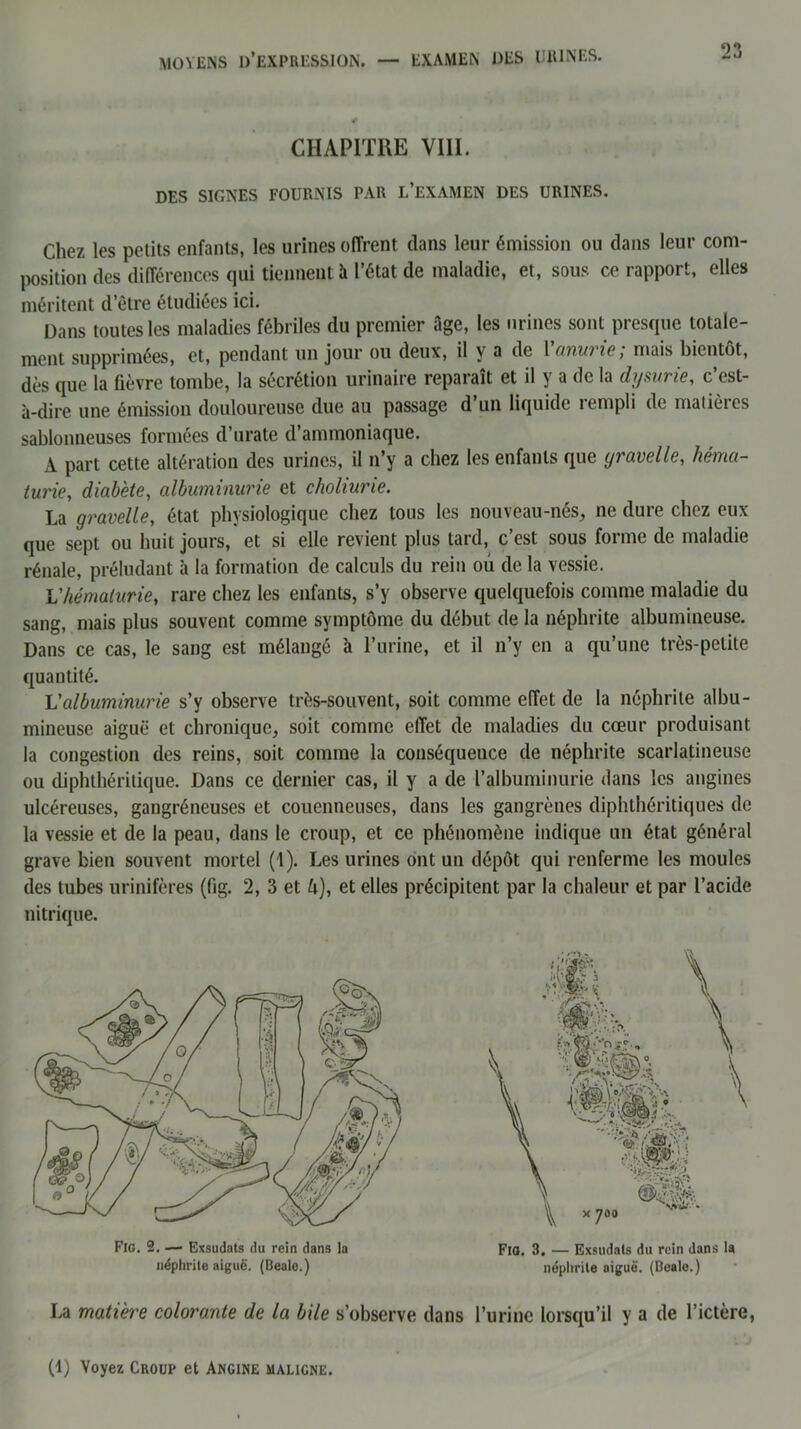 CHAPITRE VIII. DES SIGNES FOURNIS PAR L’EXAMEN DES URINES. Chez les petits enfants, les urines offrent dans leur émission ou dans leur com- position des différences qui tiennent à l’état de maladie, et, sous ce rapport, elles méritent d’être étudiées ici. Dans toutes les maladies fébriles du premier tige, les urines sont presque totale- ment supprimées, et, pendant un jour ou deux, il y a de 1 anui ic, niais bientôt, dès que la fièvre tombe, la sécrétion urinaire reparaît et il y a de la dysurie, c’est- à-dire une émission douloureuse due au passage d’un liquide rempli de matières sablonneuses formées d’urate d’ammoniaque. A part cette altération des urines, il n’y a chez les enfants que yravelle, héma- turie, diabète, albuminurie et choliurie. La gravelle, état physiologique chez tous les nouveau-nés, ne dure chez eux que sept ou huit jours, et si elle revient plus tard, c’est sous forme de maladie rénale, préludant à la formation de calculs du rein ou de la vessie. L'hématurie, rare chez les enfants, s’y observe quelquefois comme maladie du sang, mais plus souvent comme symptôme du début de la néphrite albumineuse. Dans ce cas, le sang est mélangé à l’urine, et il n’y en a qu’une très-petite quantité. L'albuminurie s’y observe très-souvent, soit comme effet de la néphrite albu- mineuse aiguë et chronique, soit comme effet de maladies du cœur produisant la congestion des reins, soit comme la conséquence de néphrite scarlatineuse ou diphthéritique. Dans ce dernier cas, il y a de l’albuminurie dans les angines ulcéreuses, gangréneuses et couenneuses, dans les gangrènes diphthéritiques de la vessie et de la peau, dans le croup, et ce phénomène indique un état général grave bien souvent mortel (1). Les urines ont un dépôt qui renferme les moules des tubes urinifères (fig. 2, 3 et h), et elles précipitent par la chaleur et par l’acide La matière colorante de la bile s’observe dans l’urine lorsqu’il y a de l’ictère, nitrique. Fig. 2. — Exsudais du rein dans la néphrite aiguë. (Beale.) Fio. 3. — Exsudais du rein dans la néphrite aiguë. (Beale.) (1) Voyez Croup et Angine maligne.