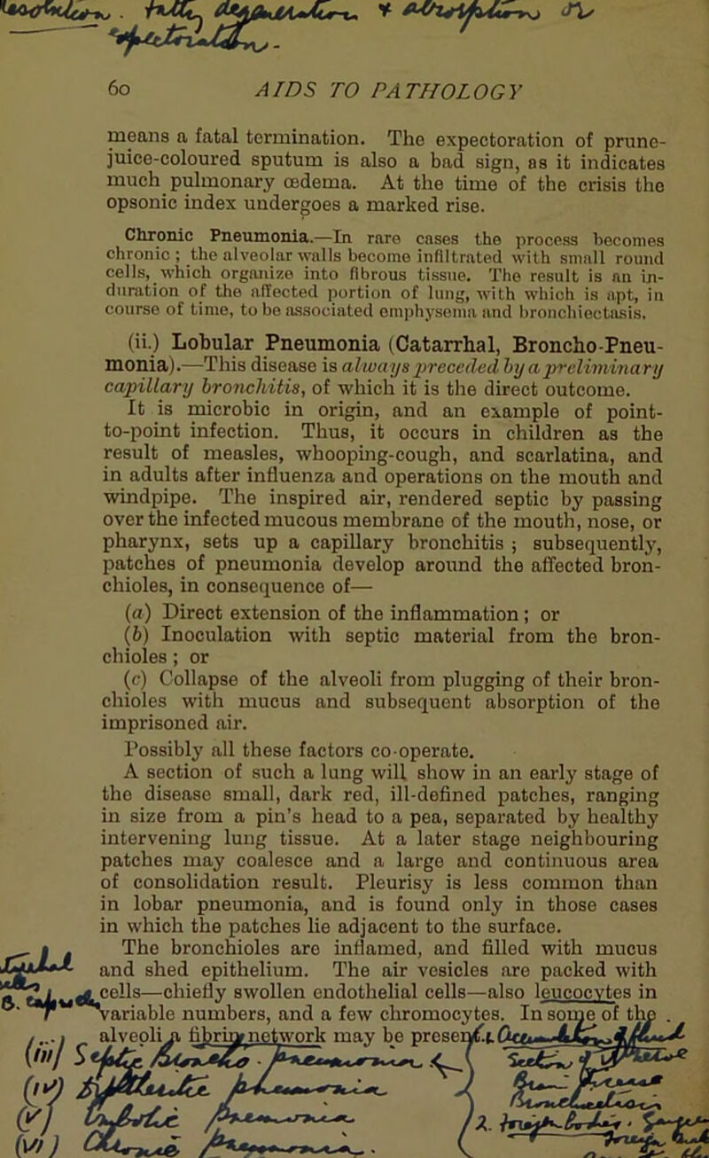 * . rulu <rlfwur-ysj <r\. 60 yi/Z)5 TO PATHOLOGY means a fatal termination. The expectoration of prune- juice-coloured sputum is also a bad sign, as it indicates much pulmonary oedema. At the time of the crisis the opsonic index undergoes a marked rise. Chronic Pneumonia.—In rare cases the process becomes chronic ; the alveolar walls become infiltrated with small round cells, which organize into fibrous tissue. The result is an in- duration of the affected portion of lung, with which is apt, in course of time, to be associated emphysema and bronchiectasis. jCjjJLa. (ii.) Lobular Pneumonia (Catarrhal, Broncho-Pneu- monia).—This disease is always preceded by a preliminary capillary bronchitis, of which it is the direct outcome. It is microbic in origin, and an example of point- to-point infection. Thus, it occurs in children as the result of measles, whooping-cough, and scarlatina, and in adults after influenza and operations on the mouth and windpipe. The inspired air, rendered septic by passing over the infected mucous membrane of the mouth, nose, or pharynx, sets up a capillary bronchitis ; subsequently, patches of pneumonia develop around the affected bron- chioles, in consequence of— (a) Direct extension of the inflammation; or (b) Inoculation with septic material from the bron- chioles ; or (c) Collapse of the alveoli from plugging of their bron- chioles with mucus and subsequent absorption of the imprisoned air. Possibly all these factors co operate. A section of such a lung will show in an early stage of the disease small, dark red, ill-defined patches, ranging in size from a pin’s head to a pea, separated by healthy intervening lung tissue. At a later stage neighbouring patches may coalesce and a large and continuous area of consolidation result. Pleurisy is less common than in lobar pneumonia, and is found only in those cases in which the patches lie adjacent to the surface. The bronchioles are inflamed, and filled with mucus and shed epithelium. The air vesicles are packed with cells—chiefly swollen endothelial cells—also leucocytes in variable numbers, and a few chromocytes. alveoli a fibriynetwork may be preser es. in some o: L, £ A x ^ L - . S' t-/-.