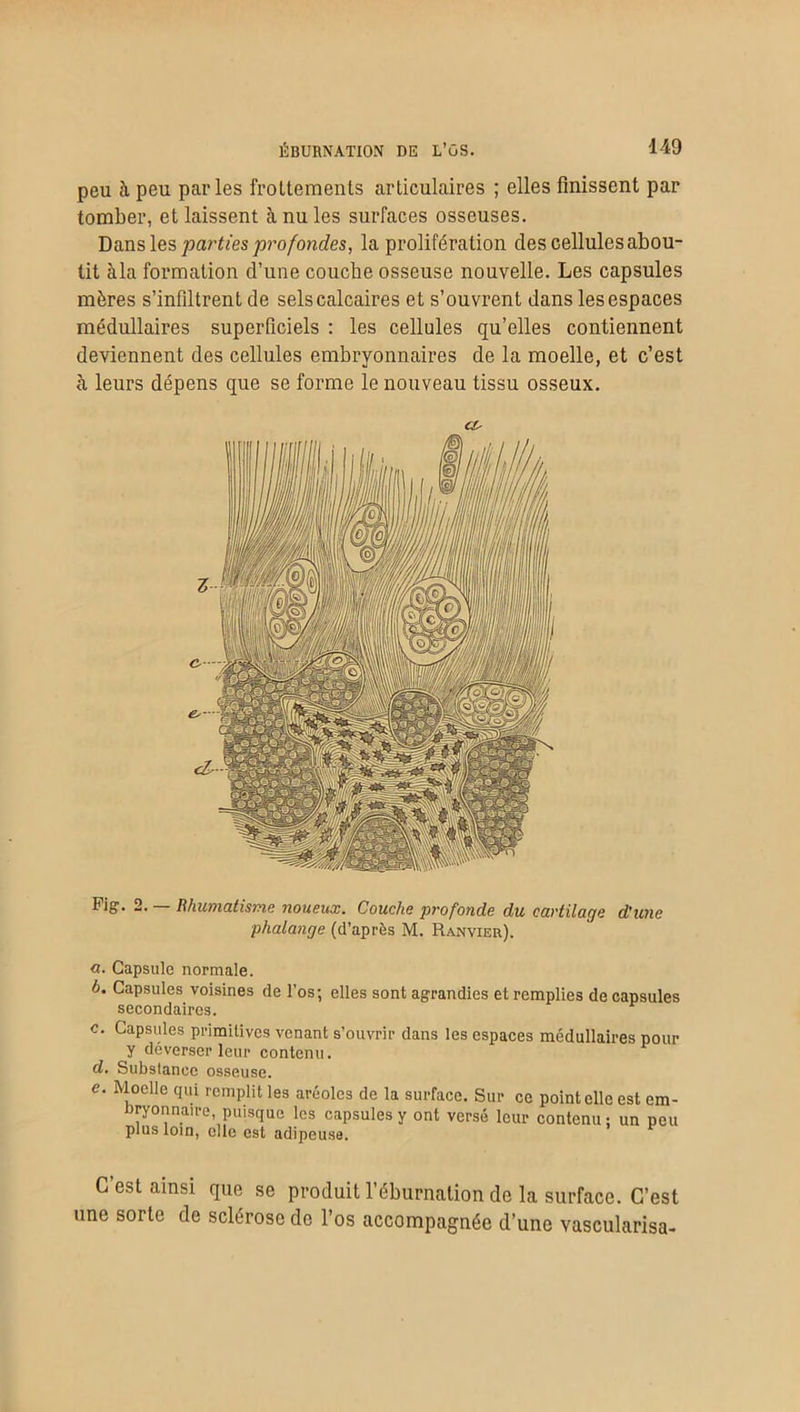 peu à peu parles frottements articulaires ; elles finissent par tomber, et laissent à nu les surfaces osseuses. Dans les parties profondes, la prolifération des cellules abou- tit àla formation d’une couche osseuse nouvelle. Les capsules mères s’infdtrent de sels calcaires et s’ouvrent dans les espaces médullaires superficiels : les cellules qu’elles contiennent deviennent des cellules embryonnaires de la moelle, et c’est «à leurs dépens que se forme le nouveau tissu osseux. CL Fig. 2. — Rhumatisme noueux. Couche profonde du cartilage d'une phalange (d’après M. Ranvier). a. Capsule normale. b. Capsules voisines de l'os; elles sont agrandies et remplies de capsules secondaires. c. Capsules primitives venant s’ouvrir dans les espaces médullaires pour y déverser leur contenu. d. Substance osseuse. c. Moelle qui remplit les aréoles de la surface. Sur ce point elle est em- bryonnaire, puisque les capsules y ont versé leur contenu ; un peu plus loin, elle est adipeuse. C’est ainsi que se produit l’éburnalion de la surface. C’est une sorte de sclérose de l’os accompagnée d’une vascularisa-
