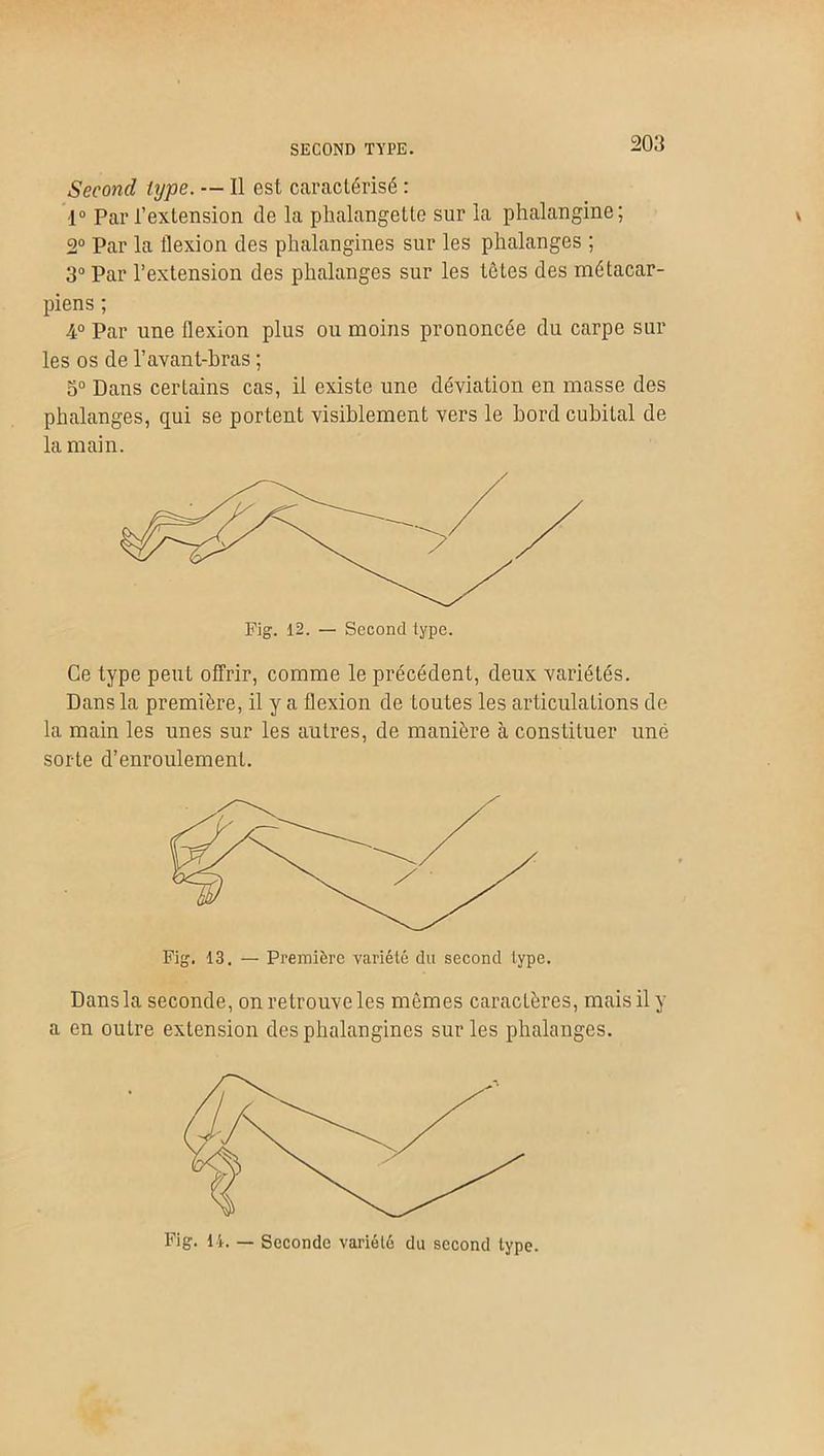 SECOND TYPE. Second type. — Il est caractérisé : 1° Par l’extension de la phalangette sur la phalangine; 2° Par la flexion des phalangines sur les phalanges ; 3° Par l’extension des phalanges sur les tètes des métacar- piens ; 4° Par une flexion plus ou moins prononcée du carpe sur les os de l’avant-bras ; 5° Dans certains cas, il existe une déviation en masse des phalanges, qui se portent visiblement vers le bord cubital de la main. Ce type peut offrir, comme le précédent, deux variétés. Dans la première, il y a flexion de toutes les articulations de la main les unes sur les autres, de manière à constituer une sorte d’enroulement. Fig. 13. — Première variété du second type. Dans la seconde, on retrouve les mômes caractères, mais il y a en outre extension des phalangines sur les phalanges.