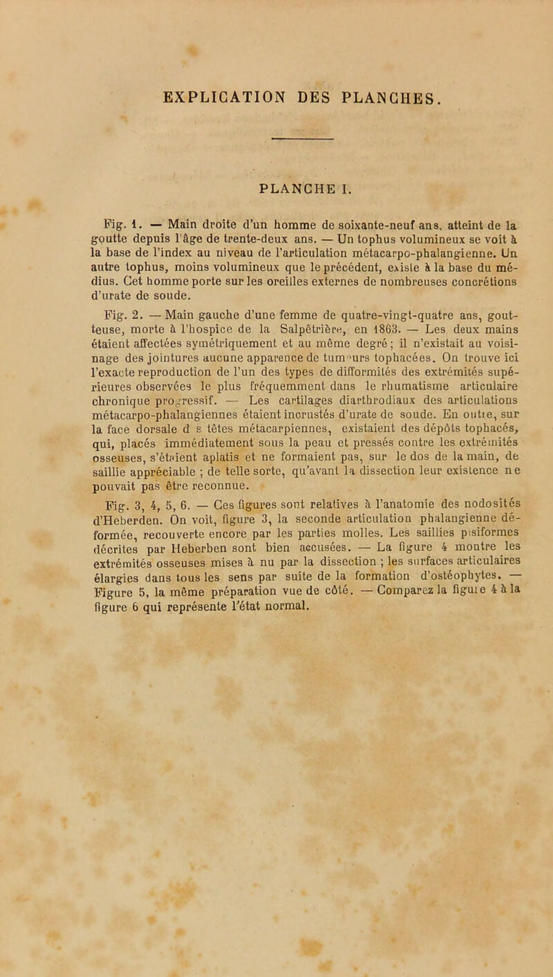EXPLICATION DES PLANCHES. PLANCHE I. Fig. i. — Main droite d’un homme de soixante-neuf ans, atteint de la gputte depuis 1 âge de trente-deux ans. — Un tophus volumineux se voit à la base de l’index au niveau de l’articulation métacarpo-phalangienne. Un autre tophus, moins volumineux que le précédent, existe à la base du mé- dius. Cet homme porte sur les oreilles externes de nombreuses concrétions d’urate de soude. Fig. 2. —Main gauche d’une femme de quatre-vingt-quatre ans, gout- teuse, morte à l’hospice de la Salpêtrière, en 1863. — Les deux mains étaient affectées symétriquement et au même degré ; il n’existait au voisi- nage des jointures aucune apparence de tumrurs tophacées. On trouve ici l’exacte reproduction de l’un des types de difformités des extrémités supé- rieures observées le plus fréquemment dans le rhumatisme articulaire chronique progressif. — Les cartilages diarthrodiaux des articulations métacarpo-phalangiennes étaient incrustés d’urate de soude. En ontie, sur la face dorsale d s têtes métacarpiennes, existaient des dépôts tophacés, qui, placés immédiatement sous la peau et pressés contre les extrémités osseuses, s’étrient aplatis et ne formaient pas, sur le dos de la main, de saillie appréciable ; de telle sorte, qu’avant la dissection leur existence ne pouvait pas être reconnue. Fig. 3, 4, 5, 6. — Ces figures sont relatives St l’anatomie des nodosités d’Heberden. On voit, figure 3, la seconde articulation phalangienne dé- formée, recouverte encore par les parties molles. Les saillies pisiformes décrites par Heberben sont bien accusées. — La figure 4 montre les extrémités osseuses mises à nu par la dissection ; les surfaces articulaires élargies dans tous les sens par suite de la formation d’ostéophytes. — Figure 5, la même préparation vue de côté. — Comparez la figuie 4 à la