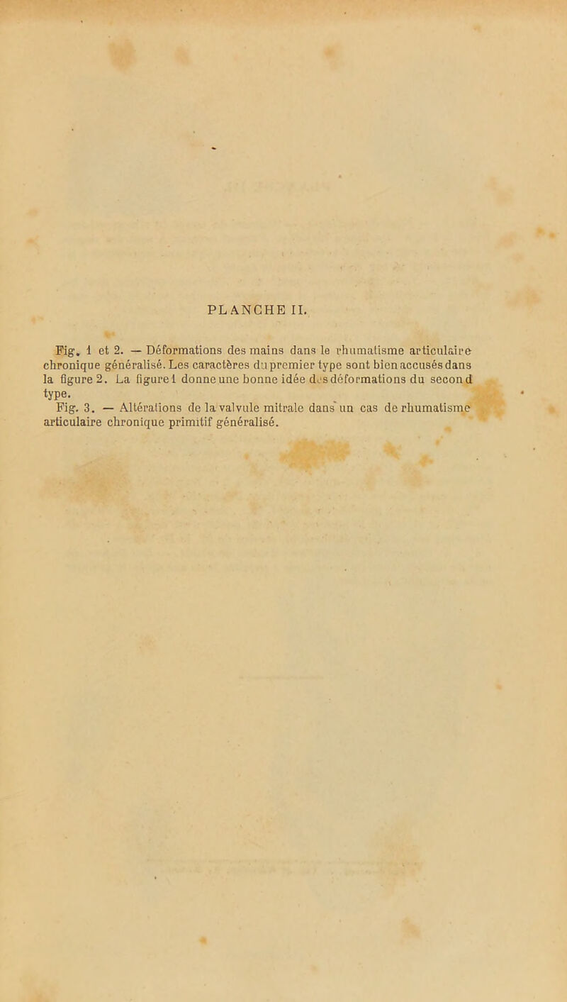 Fig. 1 et 2. — Déformations des mains dans le rhumatisme articulaire chronique généralisé. Les caractères dupremier type sont bien accusés dans la figure 2. La figurel donne une bonne idée des déformations du second type. Fig. 3. — Altérations de la valvule mitrale dans un cas de rhumatisme articulaire chronique primitif généralisé.