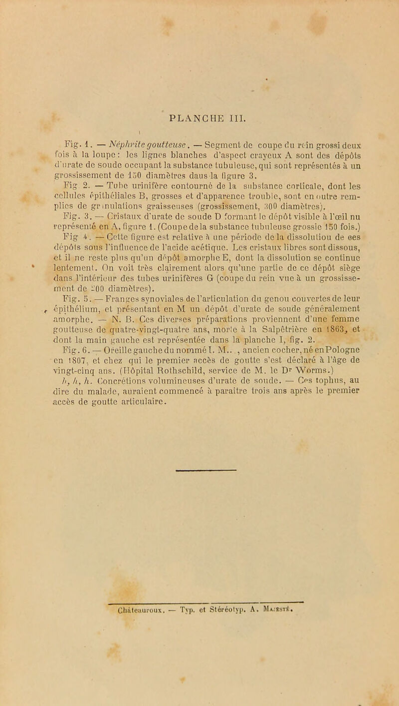 Fig. 1. — Néphrite goutteuse. — Segment de coupe du rein grossi deux fois ii la loupe: les lignes blanches d’aspect crayeux A sont des dépôts d'urate de soude occupant la substance tubuleuse, qui sont représentés à un grossissement de 150 diamètres daus la ligure 3. Fig 2. — Tube urinifère contourné de la substance corticale, dont les cellules épithéliales B, grosses et d’apparence trouble, sont en outre rem- plies de gr initiations graisseuses (grossissement, 300 diamètres). Fig. 3. — Cristaux d'urate de soude D formant le dépôt visible à l’œil nu représenté en A, figure 1. (Coupe de la substance tubuleuse grossie 150 fois.) Fig 4. —Celte figure est relative ?i une période delà dissoluliou de ces dépôts sous l'influence de l’acide acétique. Les cristaux libres sont dissous, et il ne reste plus qu’un dépôt amorphe E, dont la dissolution se continue lentement. On voit très clairement alors qu’une partie de ce dépôt siège dans l’intérieur des tubes urinifères G (coupe du rein vue à un grossisse- ment de -00 diamètres). Fig. 5. — Franges synoviales de l’articulation du genou couvertes de leur r épithélium, et présentant en M un dépôt d’urate de soude généralement amorphe. — N. B. Ces diverses préparations proviennent d’une femme goutteuse de quatre-vingt-quatre ans, morle à la Salpêtrière en 1863, et dont la main gauche est représentée dans la planche I, fig. 2. Fig. 6. — Oreille gauche du nommé I. M.. , ancien cocher, né en Pologne en 1807. et chez qui le premier accès de goutte s’est déclaré à l’àge de vingt-cinq ans. (Hôpital Rothschild, service de M. le Dr Worms.) h, h, h. Concrétions volumineuses d’urate de soude. — Ces tophus, au dire du malade, auraient commencé à paraître trois ans après le premier accès de goutte articulaire. Cliàlcaiii'oux. Tvp. et Stéréotyp. A. Majesté.