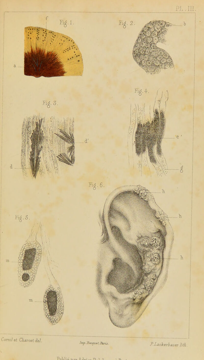PL. 111 Comil et Charcot del. Jmp .2?o<yti e i. Paris. P. J <3 cher b auer lith P«U,« A J..: i i