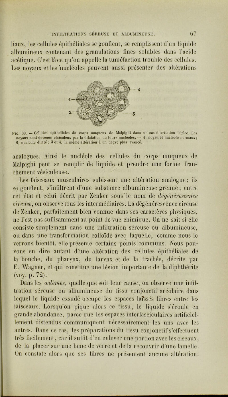 liaiix, l(3s cellules cpilhélialos se gonllenl, se remplissent truii liquide albumineux contenant des granulalions fines solubles dans l’acide acétique. C’est là ce qu’on appelle la tumélaction trouble des cellules. Les noyaux et les 'nucléoles peuvent aussi présenter des altérations Fig. 30. — Cellules cpiihéliales du corps iiiuqucux de Malpigiii dans un cas d’irrilalioii légère. Les noyaux sont devenus vésiculeux par la dilatation de leurs nucléoles.— 1, noyau et nucléole normaux; 2, nucléole dilaté; 3 et 4, la même altération à un degré plus avancé. analogues. Ainsi le nucléole des cellules du corps muqueux de Malpig'bi peut se remplir de liquide et prendre une forme fran- chement vésicLileuse. Les làisceaux musculaires subissent une altération analogue; ils se gonflent, s’infiltrent d’une substance albumineuse grenue ; entre cet état et celui décrit par Zenker sous le nom de dégénérescence cireuse, on observe tous les intermédiaires. La dégénérescence cireuse de Zenker, parfaitement bien connue dans ses caractères physiques, ne l’est pas suffisamment au point de vue chimique. On ne sait si elle consiste simplement dans une infiltration séreuse ou albumineuse, ou dans une transformation colloïde avec laquelle, comme nous le verrons bientôt, elle présente certains points communs. Nous pou- vons en dire autant d’une altération des cellules épithéliales de la bouche, du pharynx, du larynx et de la trachée, décrite par E. Wagner, et qui constitue une lésion importante de la diphthérite (voy. p. 72). Dans les œdèmes, quelle que soit leur cause, on observe une infil- tration séreuse ou albumineuse du tissu conjonctif aréolaire dans lequel le liquide exsudé occupe les espaces lafssés libres entre les faisceaux. Lorsqu’on pique alors ce tissu, le liquide s’écoule en grande abondance, parce que h^s espaces interfasciculaires artificiel- lement distendus communi([uent nécessairement les uns avec les autres. Dans ce cas, les préparations du tissu conjonclirs’eflècluent très facilement, car il suffit d’en enlever une })ortion avec les ciseaux, de la placer sur une lame de verre et de la recouvrii* d’une lamelle. On constate alors que ses fibres ne 'présentent aucune altération.