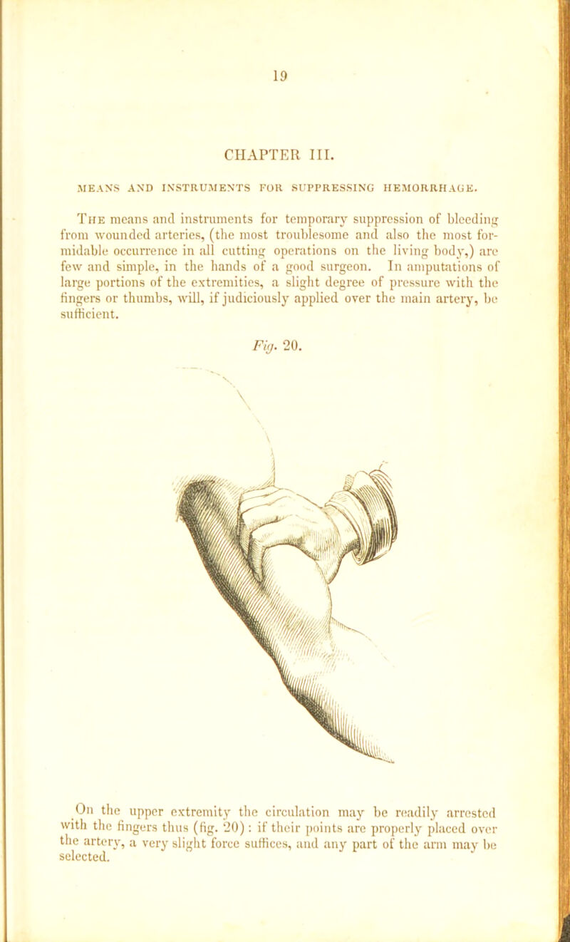 CHAPTER III. MEANS AND INSTRUMENTS FOR SUPPRESSING HEMORRHAGE. The means and instruments for temporary suppression of bleeding from wounded arteries, (the most troublesome and also the most for- midable occurrence in all cutting operations on the living body,) are few and simple, in the hands of a good surgeon. In amputations of large portions of the extremities, a slight degree of pressure with the lingers or thumbs, will, if judiciously applied over the main artery, be sufficient. Fig. 20. On the upper extremity the circulation may be readily arrested with the lingers thus (fig. 20): if their points are properly placed over the artery, a very slight force suffices, and any part of the arm may be selected.