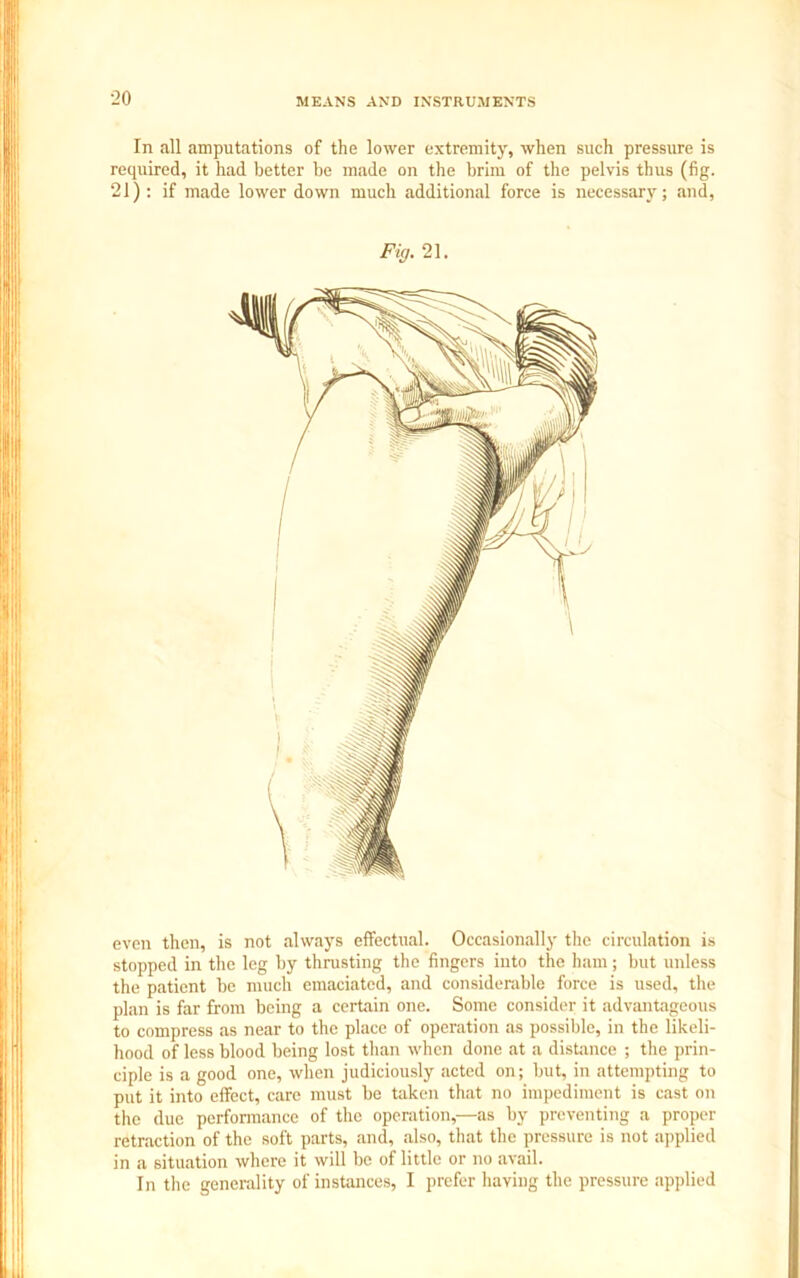 In all amputations of the lower extremity, when such pressure is required, it had better be made on the brim of the pelvis thus (fig. 21): if made lower down much additional force is necessary; and, Fig. 21. stopped in the leg by thrusting the fingers into the ham; but unless the patient be much emaciated, and considerable force is used, the plan is far from being a certain one. Some consider it advantageous to compress as near to the place of operation as possible, in the likeli- hood of less blood being lost than when done at a distance ; the prin- ciple is a good one, when judiciously acted on; but, in attempting to put it into effect, care must be taken that no impediment is cast on the due performance of the operation,—as by preventing a proper retraction of the soft parts, and, also, that the pressure is not applied in a situation where it will be of little or no avail. In the generality of instances, I prefer having the pressure applied