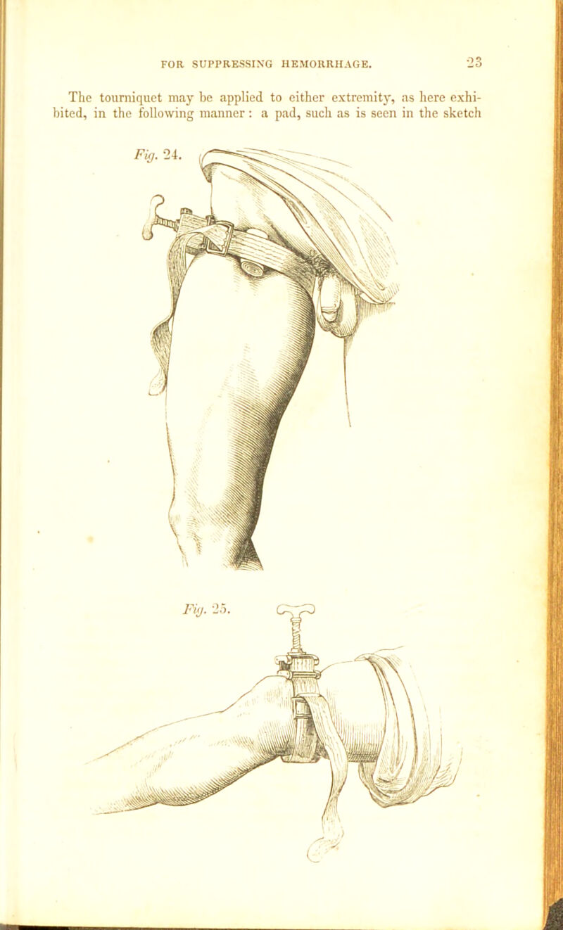 The tourniquet may be applied to either extremity, as here exhi- bited, in the following manner: a pad, such as is seen in the sketch