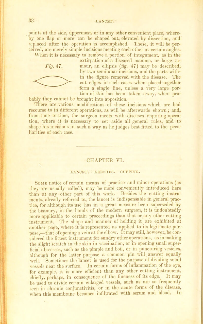 points at the side, uppermost, or in any other convenient place, where- by one flap or more can be shaped out, elevated by dissection, and replaced after the operation is accomplished. These, it will be per- ceived, are merely simple incisions meeting each other at certain angles. When it is necessary to remove a portion of integument, as in the extirpation of a diseased mamma, or large tu- Fig. 47. mour, an ellipsis (fig. 47) may be described, by two semilunar incisions, and the parts with- in the figure removed with the disease. The cut edges in such cases when placed together form a single line, unless a very large por- tion of skin has been taken away, when pro- bably they cannot be brought into apposition. There are various modifications of these incisions which are had recourse to in different operations, as will be afterwards shown; and, from time to time, the surgeon meets with diseases requiring opera- tion, where it is necessary to set aside all general rules, and to shape his incisions in such a way as he judges best fitted to the pecu- liarities of each case. CHAPTER VI. LANCET. LEECHES. CUPPING. Some notice of certain means of practice and minor operations (as they are usually called), may be more conveniently introduced here than at any other part of this work. Besides the cutting instru- ments, already referred to, the lancet is indispensable in general prac- tice, for although its use has in a great measure been superseded by the bistoury, in the hands of the modem surgeon, it is undoubtedly more applicable to certain proceedings than that or any other cutting instrument. The shape and manner of holding it are exhibited at another page, where it is represented as applied to its legitimate pur- pose,—that of opening a vein at the elbow. It may still, however, be con- sidered the fittest instrument for sundry other operations, as in making the slight scratch in the skin in vaccination, or in opening small super- ficial abscesses, such as the pimple and boil, or in puncturing vesicles, although for the latter purpose a common pin will answer equally well. Sometimes the lancet is used for the purpose of dividing small vessels near the surface. In certain forms of inflammation of the eye, for example, it is more efficient than any other cutting instrument, chiefly, perhaps, in consequence of the fineness of its edge. It may be used to divide certain enlarged vessels, such as are so frequently seen in chronic conjunctivitis, or in the acute forms of the disease, when this membrane becomes infiltrated with serum and blood. In