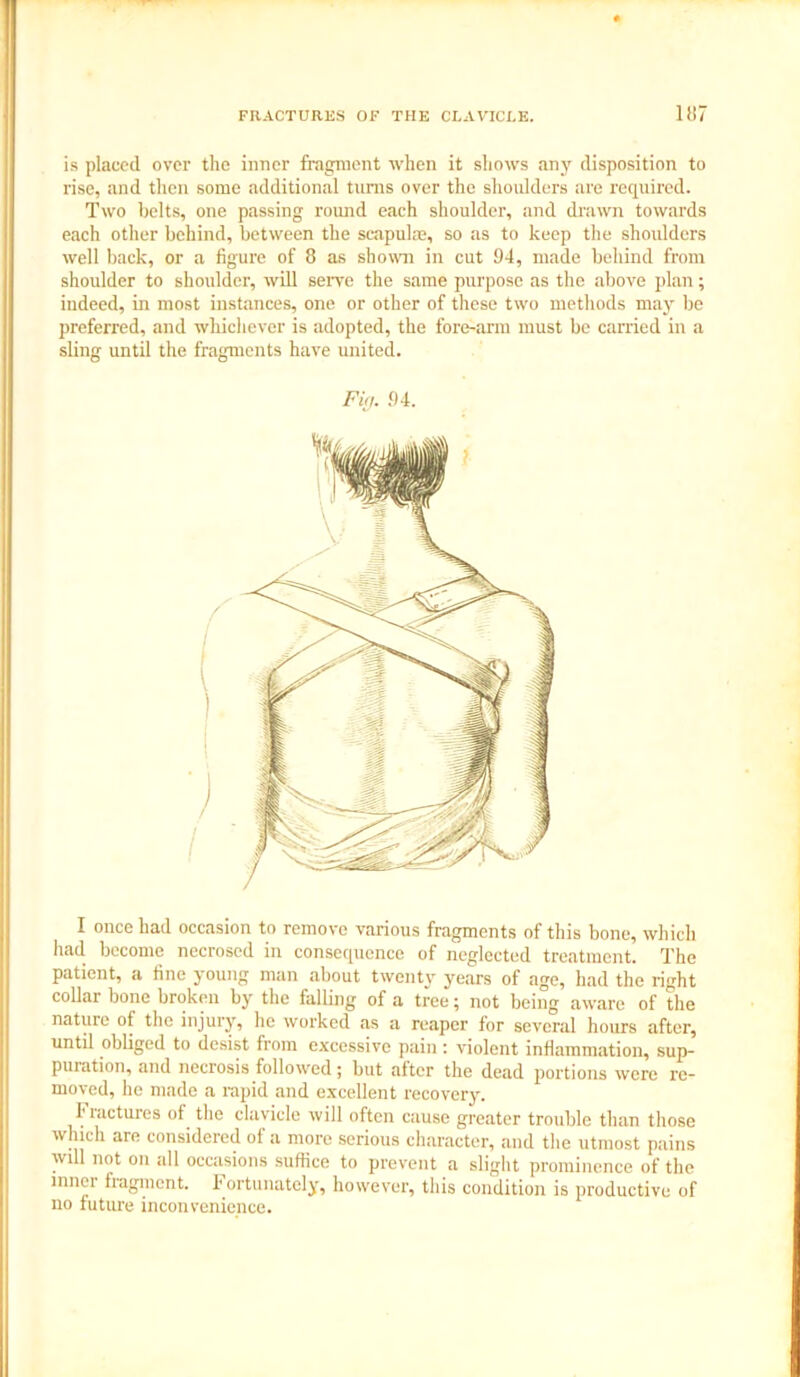 is placed over the inner fragment when it shows any disposition to rise, and then some additional turns over the shoulders are required. Two belts, one passing round each shoulder, and drawn towards each other behind, between the scapulae, so as to keep the shoulders well back, or a figure of 8 as shown in cut 94, made behind from shoulder to shoulder, will serve the same purpose as the above plan; indeed, in most instances, one or other of these two methods may be preferred, and whichever is adopted, the fore-arm must be carried in a sling until the fragments have united. Fig. 94. I once had occasion to remove various fragments of this bone, which had become necrosed in consequence of neglected treatment. The patient, a fine young man about twenty years of age, had the right collar bone broken by the falling of a tree; not being aware of the nature of the injury, he worked as a reaper for several hours after, until obliged to desist from excessive pain: violent inflammation, sup- puration, and necrosis followed; but alter the dead portions were re- moved, he made a rapid and excellent recovery. Fractures of the clavicle will often cause greater trouble than those which are considered of a more serious character, and the utmost pains will not on all occasions suffice to prevent a slight prominence of the innei fragment. Fortunately, however, this condition is productive of no future inconvenience.