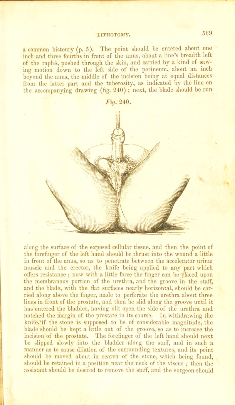 a common bistoury (p. 5). The point should be entered about one inch and three fourths in front of the anus, about a line’s breadth left of the raphe, pushed through the skin, and earned by a kind of saw- ing motion down to the left side of the perineum, about an inch beyond the anus, the middle of the incision being at equal distances from the latter part and the tuberosity, as indicated by the line on the accompanying drawing (fig. 240) ; next, the blade should be run Fig. 240. along the surface of the exposed cellular tissue, and then the point of the forefinger of the left hand should be thrust into the wound a little in front of the anus, so as to penetrate between the accelerator urinae muscle and the erector, the knife being applied to any part which offers resistance ; now with a little force the finger can be placed upon the membranous portion of the urethra, and the groove in the staff, and the blade, with the flat surfaces nearly horizontal, should be car- ried along above the finger, made to perforate the urethra about three lines in front of the prostate, and then be slid along the groove until it has entered the bladder, having slit open the side of the urethra and notched the margin of the prostate in its course. In withdrawing the knife,'if the stone is supposed to be of considerable magnitude, the blade should be kept a little out of the groove, so as to increase the incision of the prostate. The forefinger of the left hand should next be slipped slowly into the bladder along the staff, and in such a manner as to cause dilation of the surrounding textures, and its point should be moved about in search of the stone, which being found, should be retained in a position near the neck of the viscus ; then the assistant should be desired to remove the staff, and the surgeon should