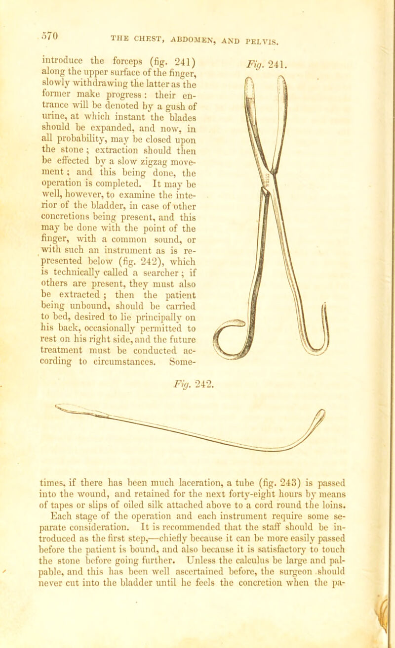introduce the forceps (fig. 241) along the upper surface of the finger, slowly withdrawing the latter as the former make progress: their en- trance will be denoted by a gush of urine, at which instant the blades should be expanded, and now, in all probability, may be closed upon the stone; extraction should then be effected by a slow zigzag move- ment ; and this being done, the operation is completed. It may be well, however, to examine the inte- rior of the bladder, in case of other concretions being present, and this may be done with the point of the finger, with a common sound, or with such an instrument as is re- presented below (fig. 242), which is technically called a searcher; if others are present, they must also be extracted ; then the patient being unbound, should be carried to bed, desired to lie principally on his back, occasionally permitted to rest on his right side, and the future treatment must be conducted ac- cording to circumstances. Some- Fig. 241. Fig. 242. times, if there has been much laceration, a tube (fig. 243) is passed into the wound, and retained for the next forty-eight hours by means of tapes or slips of oiled silk attached above to a cord round the loins. Each stage of the operation and each instrument require some se- parate consideration. It is recommended that the staff should be in- troduced as the first step,—chiefly because it can be more easily passed before the patient is bound, and also because it is satisfactory to touch the stone before going further. Unless the calculus be large and pal- pable, and this has been well ascertained before, the surgeon should never cut into the bladder until he feels the concretion when the pa-
