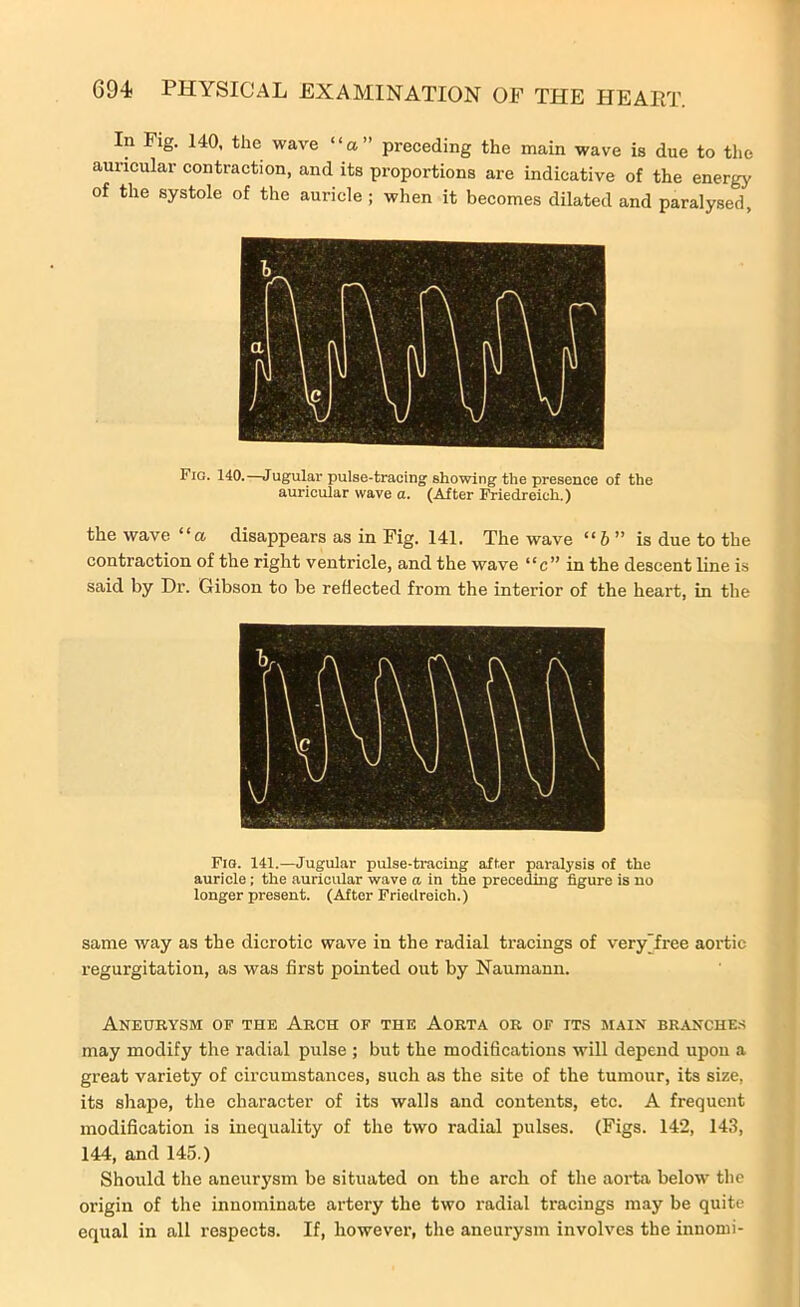 In Fig. 140. the wave “a” preceding the main wave is due to the auricular contraction, and its proportions are indicative of the energy of the systole of the auricle ; when it becomes dilated and paralysed. Fio. 140.—Jugular pulse-tracing showing the presence of the auricular wave a. (After Friedreich.) the wave “a disappears as in Fig. 141. The wave “6 ” is due to the contraction of the right ventricle, and the wave “c” in the descent line is said by Dr. Gibson to be reflected from the interior of the heart, in the Fig. 141.—Jugular pulse-tracing after paralysis of the auricle; the auricular wave a in the preceding figure is no longer present. (After Friedreich.) same way as the dicrotic wave in the radial tracings of veryfree aortic regurgitation, as was first pointed out by Naumann. Aneurysm of the Arch of the Aorta or of its main branches may modify the radial pulse ; but the modifications will depend upon a great variety of circumstances, such as the site of the tumour, its size, its shape, the character of its walls and contents, etc. A frequent modification is inequality of the two radial pulses. (Figs. 142, 143, 144, and 145.) Should the aneurysm be situated on the arch of the aorta below the origin of the innominate artery the two radial tracings may be quite equal in all respects. If, however, the aneuiysm involves the innomi-