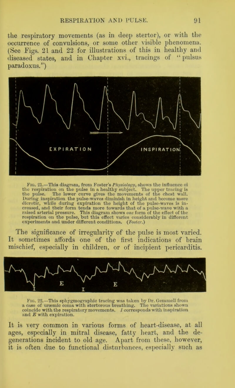 the respiratory movements (as in deep stertor), or with the occurrence of convulsions, or some other visible phenomena. (See Figs. 21 and 22 for illustrations of this in healthy and diseased states, and in Chapter xvi., tracings of “pulsus paradoxus.”) Fig. 21.—This diagram, from Foster's Physiology, shows the influence oi the respiration on the pulse in a healthy subject. The upper tracing is the pulse. The lower curve gives the movements of the chest wall. During inspiration the pulse-waves diminish in height and become more dicrotic, while during expiration the height of the pulse-waves is in- creased, and their form tends more towards that of a pulse-wave with a raised arterial pressure. This diagram shows one form of the effect of the respiration on the pulse, but this effect varies considerably in different experiments and under different conditions. (Poster.) The significance of irregularity of the pulse is most varied. It sometimes affords one of the first indications of brain mischief, especially in children, or of incipient pericarditis. Fig. 22.—This sphygmographic tracing was taken by Dr. Gemmell from a case of uraemic coma with stertorous breathing. The variations shown coincide with the respiratory movements. I corresponds with inspiration and E with expiration. It is very common in various forms of heart-disease, at all ages, especially in mitral disease, fatty heart, and the de- generations incident to old age. Apart from these, however, it is often due to functional disturbances, especially such as