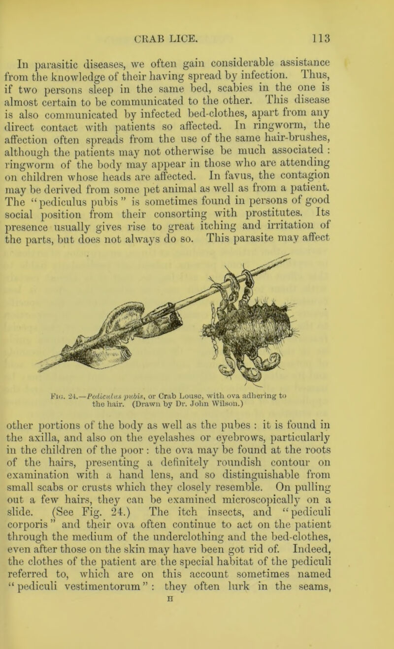 In parasitic diseases, we often gain considerable assistance from the knowledge of their having spread by infection, lhus, if two persons sleep in the same bed, scabies in the one is almost certain to be communicated to the other, i his disease is also communicated by infected bed-clothes, apart from any direct contact with patients so affected. In ringworm, the affection often spreads from the use of the same hair-brushes, although the patients may not otherwise be much associated : ringworm of the body may appear in those who are attending on children whose heads are affected. In favus, the contagion may be derived from some pet animal as well as from a patient. The “ pediculus pubis ” is sometimes found in persons of good social position from their consorting with prostitutes. Its presence usually gives rise to great itching and irritation of the parts, but does not always do so. This parasite may affect Kkj. 24.—Peiliculus px'Aix, or Crab Louse, with ova adhering to the hair. (Drawn by Dr. John Wilson.) other portions of the body as well as the pubes : it is found in the axilla, and also on the eyelashes or eyebrows, particularly in the children of the poor : the ova may be found at the roots of the hairs, presenting a definitely roundish contour on examination with a hand lens, and so distinguishable from small scabs or crusts which they closely resemble. On pulling out a few hairs, they can be examined microscopically on a slide. (See Fig. 24.) The itch insects, and “pediculi corporis ” and their ova often continue to act on the patient through the medium of the underclothing and the bed-clothes, even after those on the skin may have been got rid of. Indeed, the clothes of the patient are the special habitat of the pediculi referred to, which are on this account sometimes named “pediculi vestimentorum” : they often lurk in the seams, n